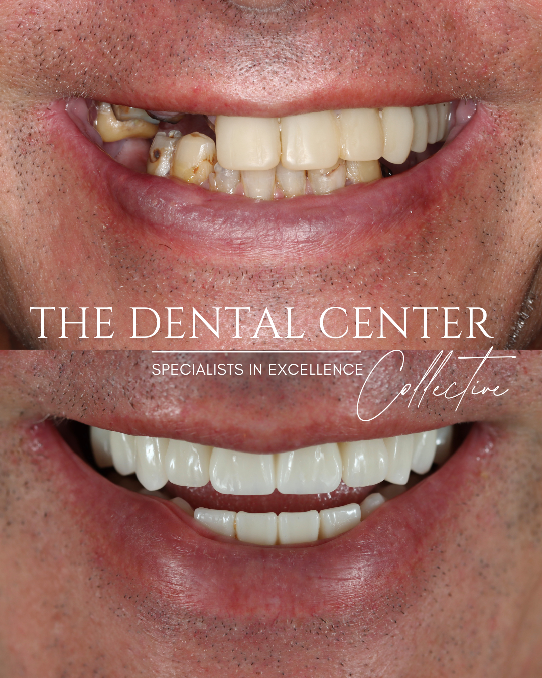 Full-mouth reconstruction using implant-supported teeth to replace damaged dentition and restore natural smile appearance and bite function.