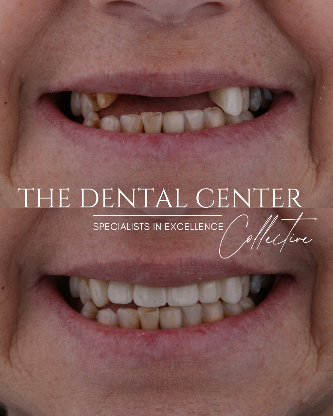 Before and after dental implants placed
