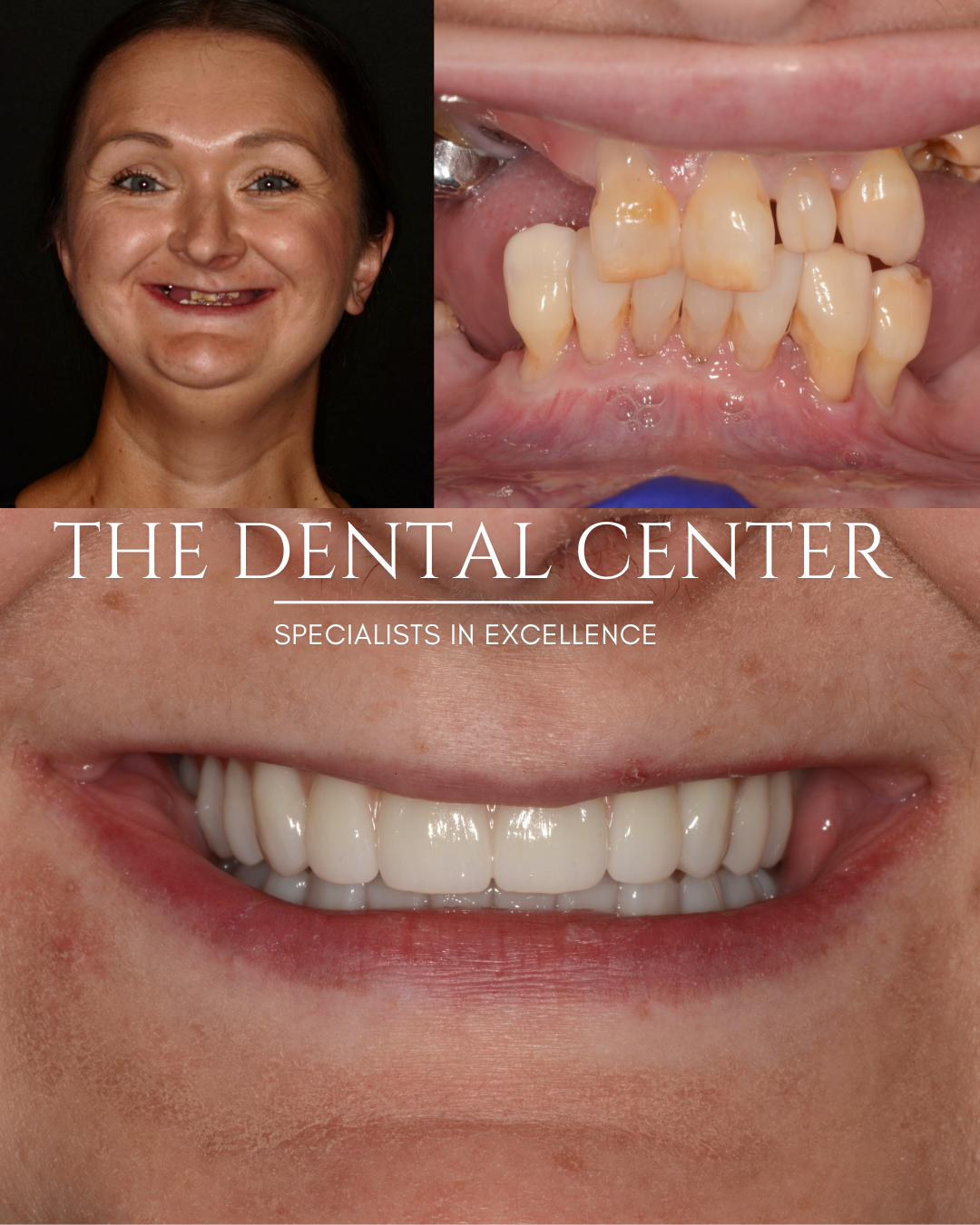 Confident mature woman smiling after All-on-4 treatment