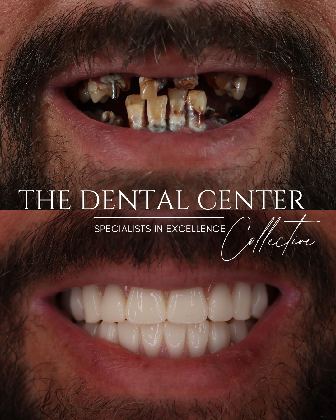Complete smile transformation to restore function, comfort, and aesthetics after extensive tooth loss and decay.