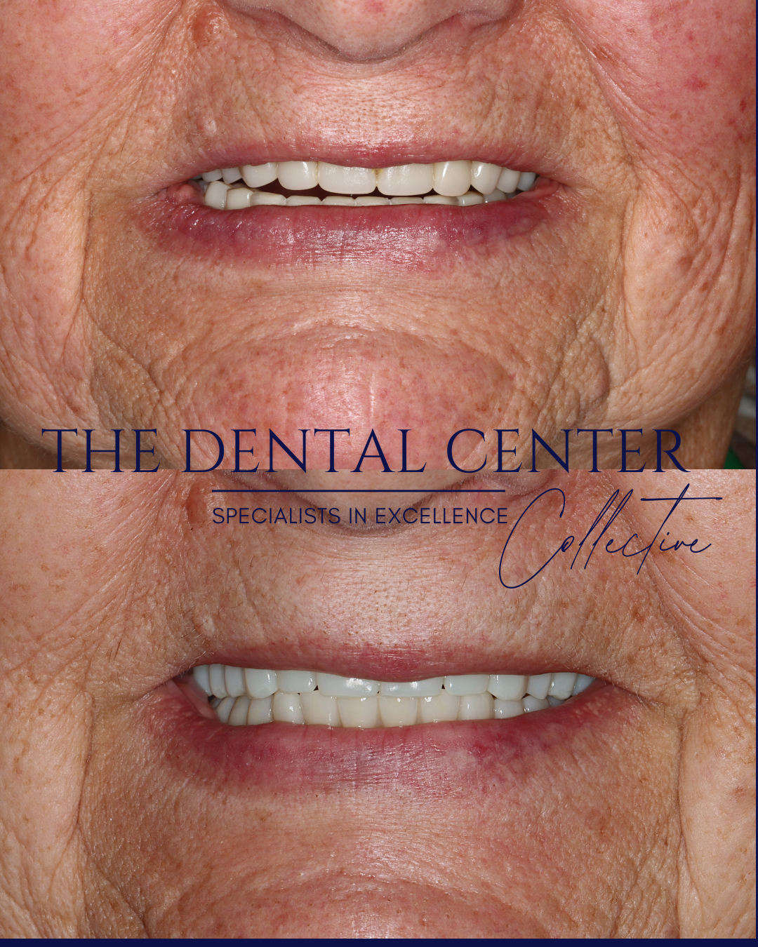Full-mouth reconstruction using implant-supported teeth to restore natural smile appearance and bite function.