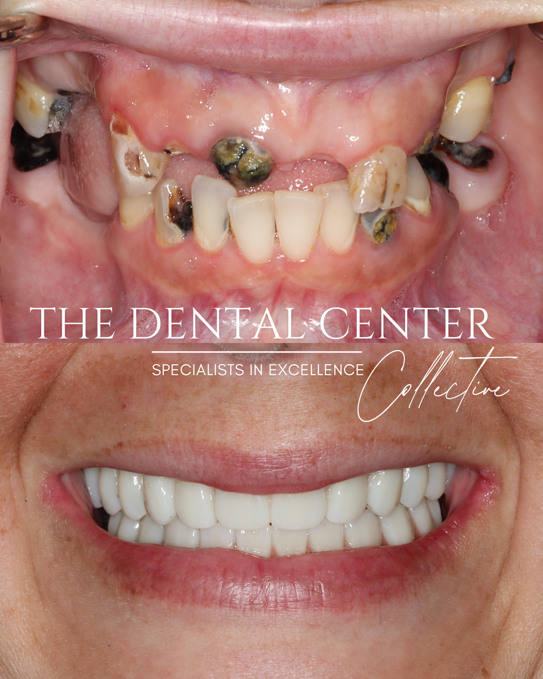 Before and after full-arch implant treatment performed in New Hampshire restoring oral health, chewing ability, and smile confidence.