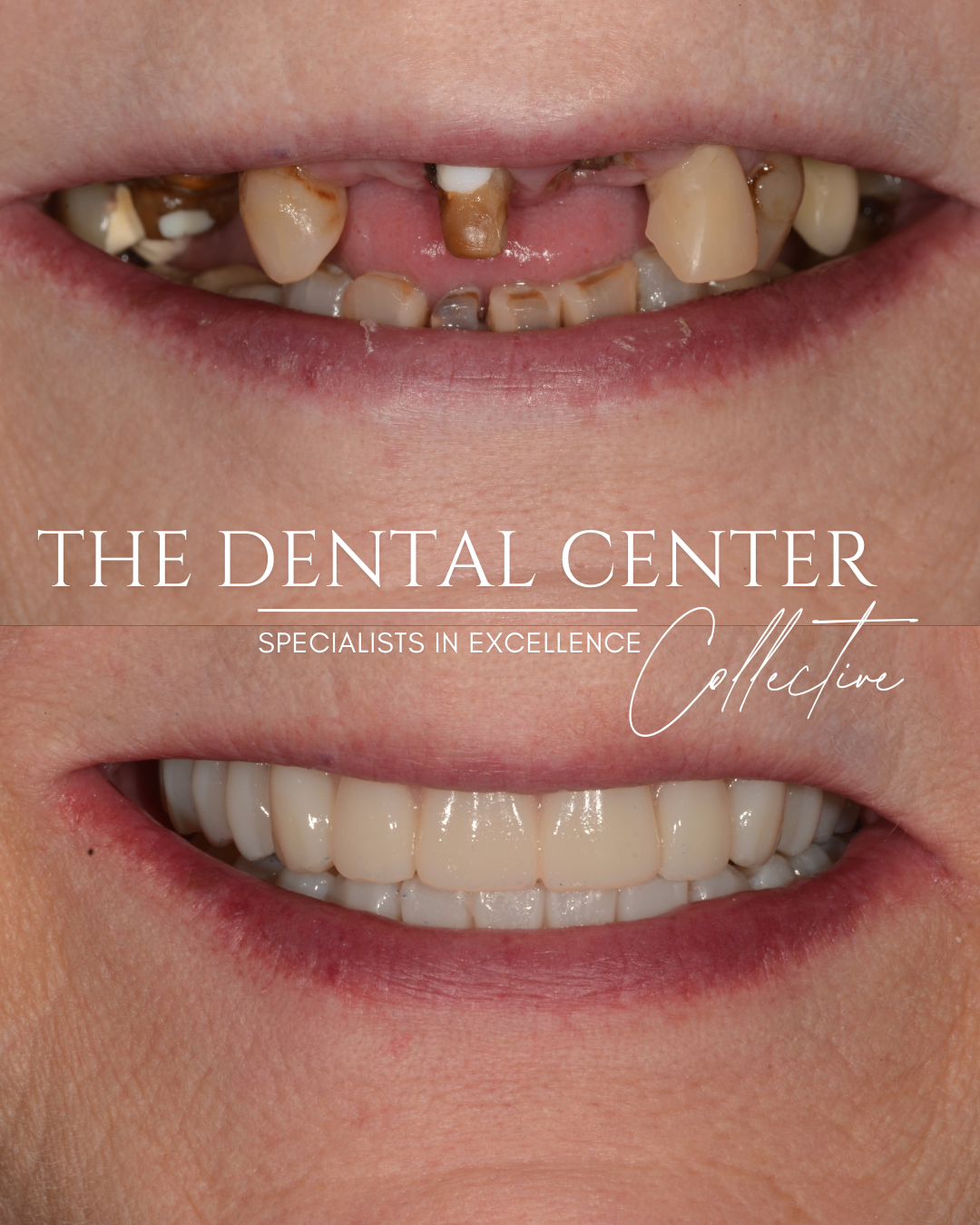 Complete smile transformation using full-mouth dental implants to restore function, comfort, and aesthetics after extensive tooth loss and decay.