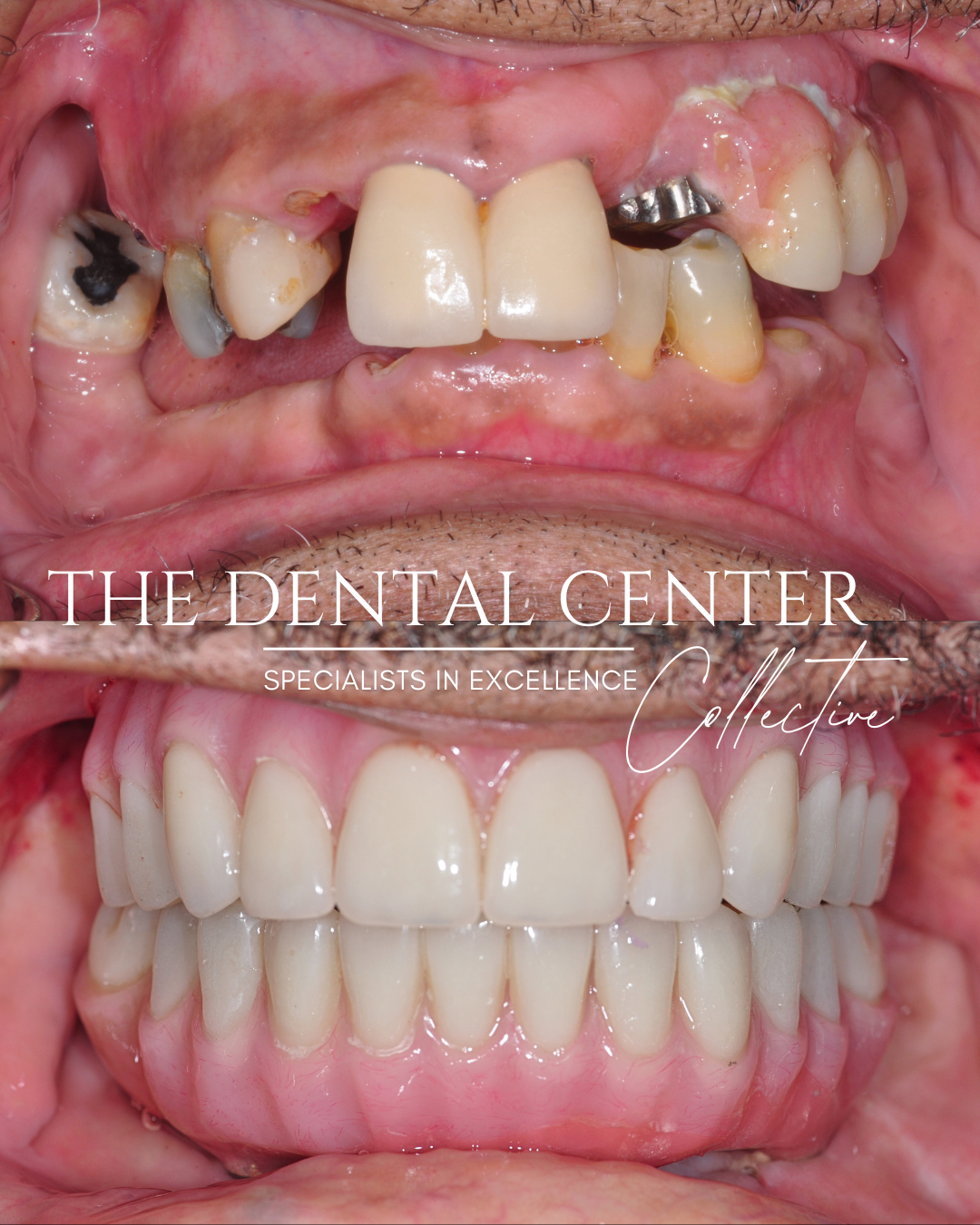 Before and after dental implant surgery