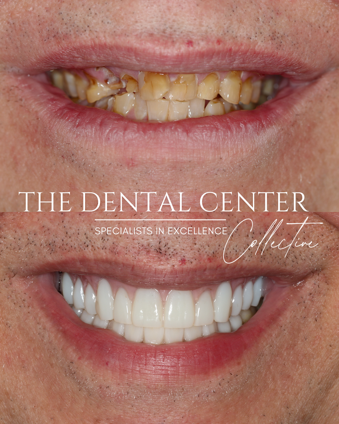Patient treated with full-mouth dental implants after extensive decay and broken teeth, resulting in a stable, natural-looking smile.