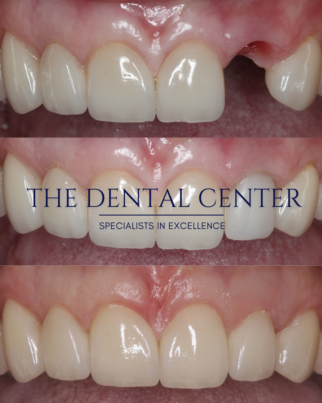 Before, during and after dental implant treatment. 