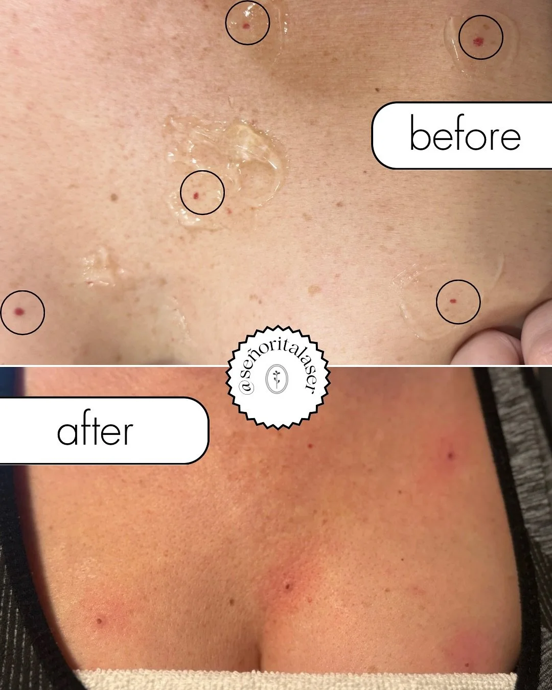 Cherry Angioma Removal with Laser 🍒⚡️ 

Say goodbye to those tiny red spots! Using the MeDioStar vascular handpiece, we safely target and fade cherry angiomas with precision and no downtime.

💡Quick Facts:
✔️Non-invasive + minimal discomfort
✔️Quic