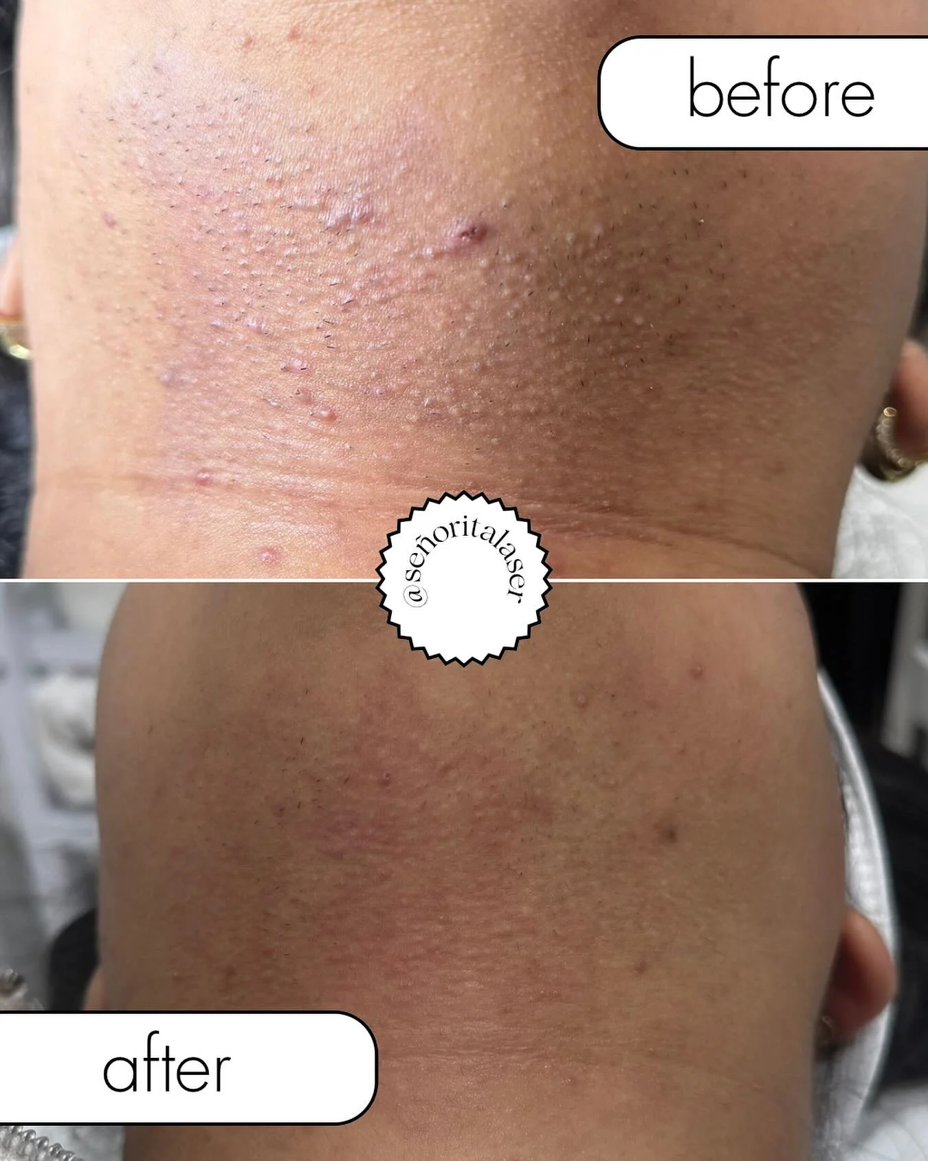 ✨ Laser Hair Removal before and after ✨

Just 3 sessions in and the results speak for themselves 🤭

Less irritation ✅
Smoother skin ✅
Visible results ✅

#laserhairremoval #skincare #beauty #skin #hamilton #skinrejuvenation #laser #hamilton #ancaster