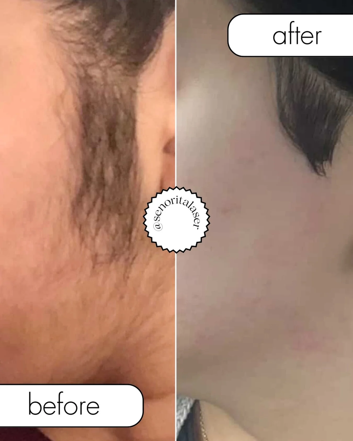 5 sessions makes all the difference✨

Every girl deserves the confidence of smooth skin. 
We didn&rsquo;t just remove the hair&mdash;we removed the daily stress and the &ldquo;mirror anxiety&rdquo; that comes with it. 🕊️

Ready for your 5-session gl