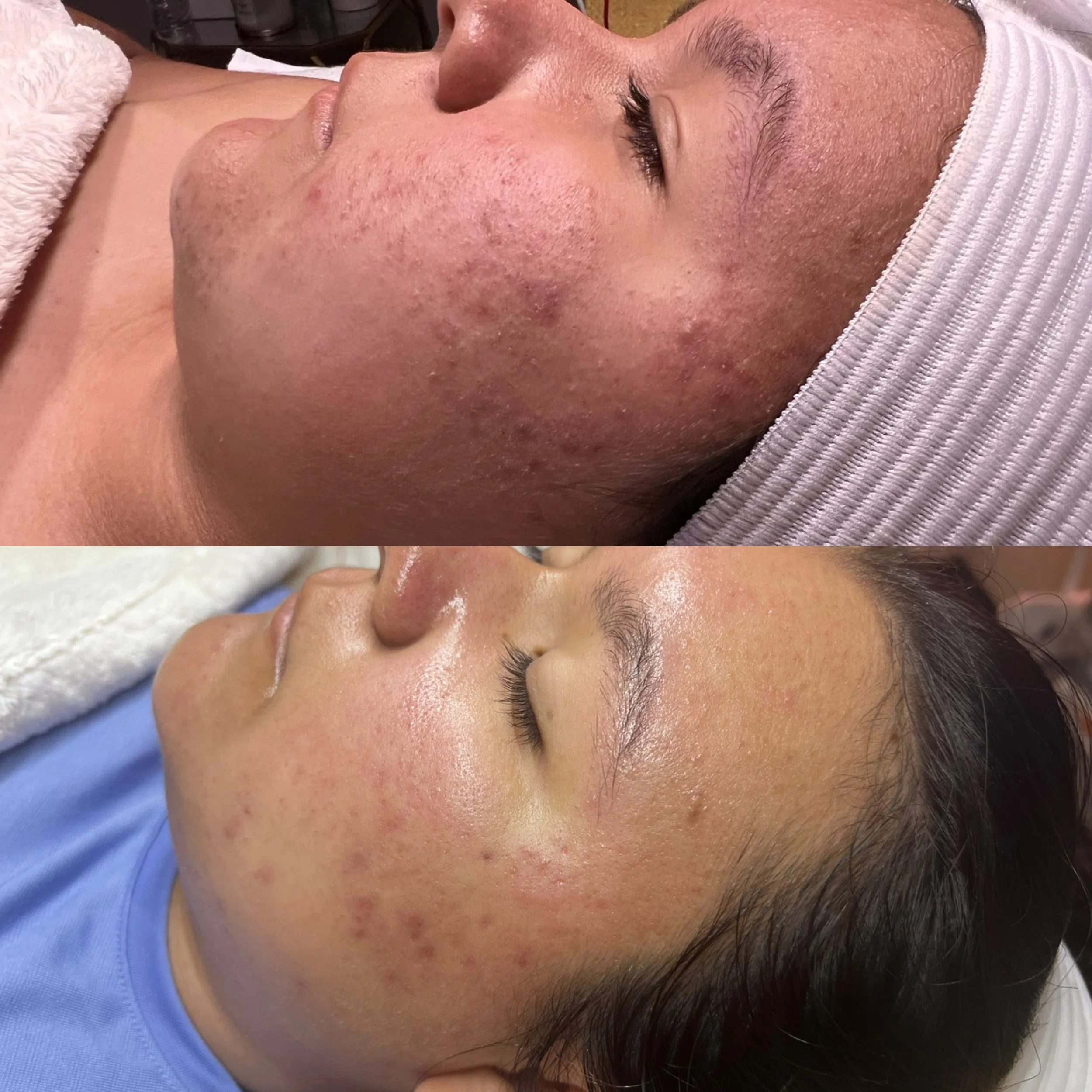 Before vs after custom facial.JPG