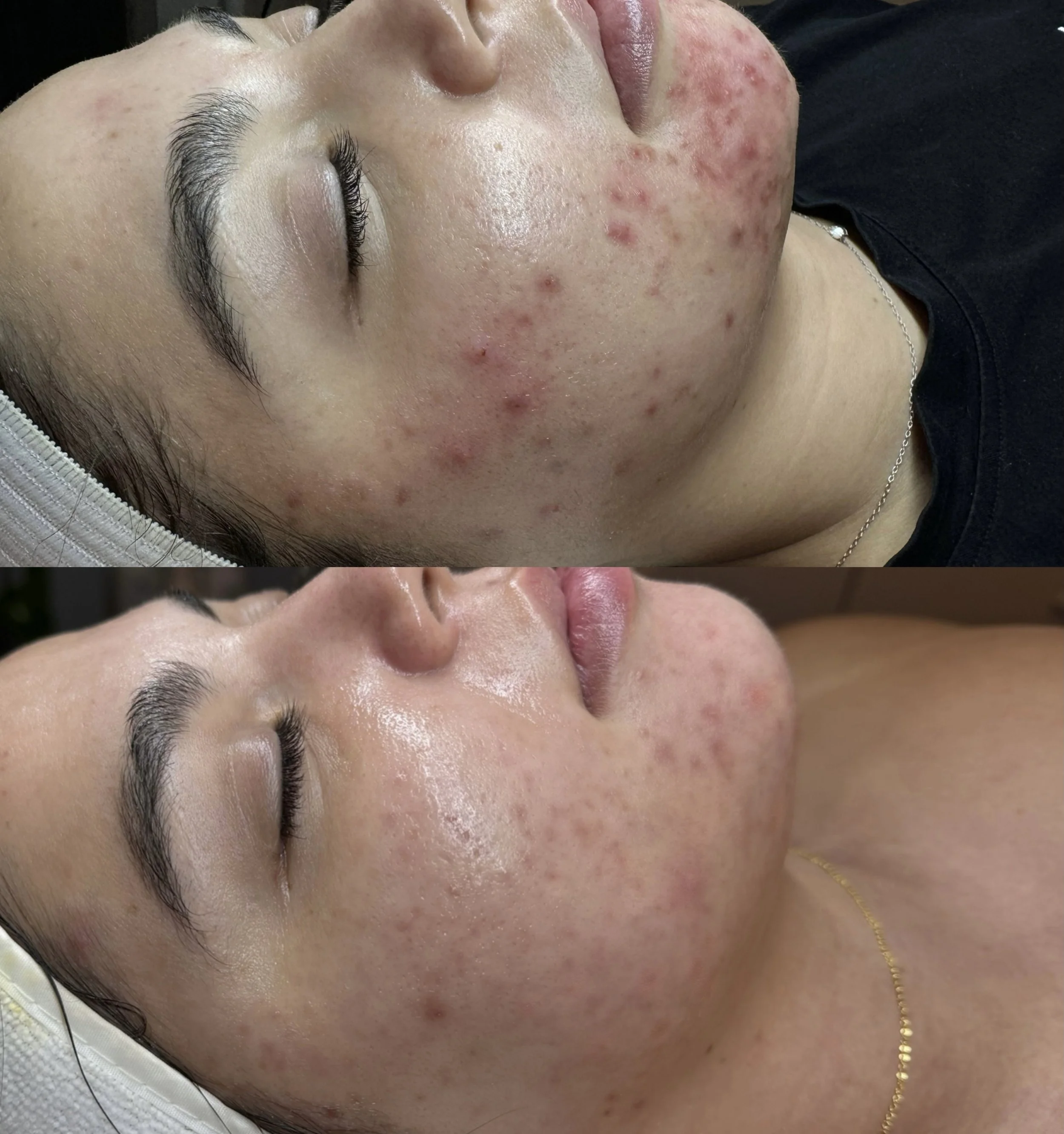 Before Vs after biorepeel.jpg