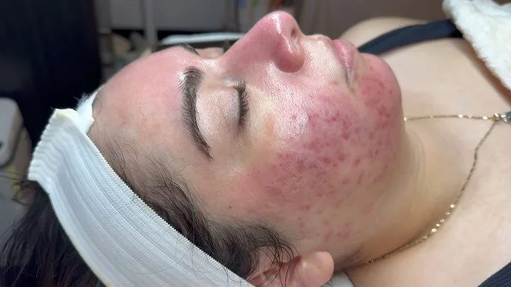 How it started vs how it&rsquo;s going ✨

Love seeing this kind of progress on my clients! Starting off with inflamed acne / pigmentation to now only dealing with slight pigmentation. 

Hormonal acne is a tough cookie to crack but it&rsquo;s definite