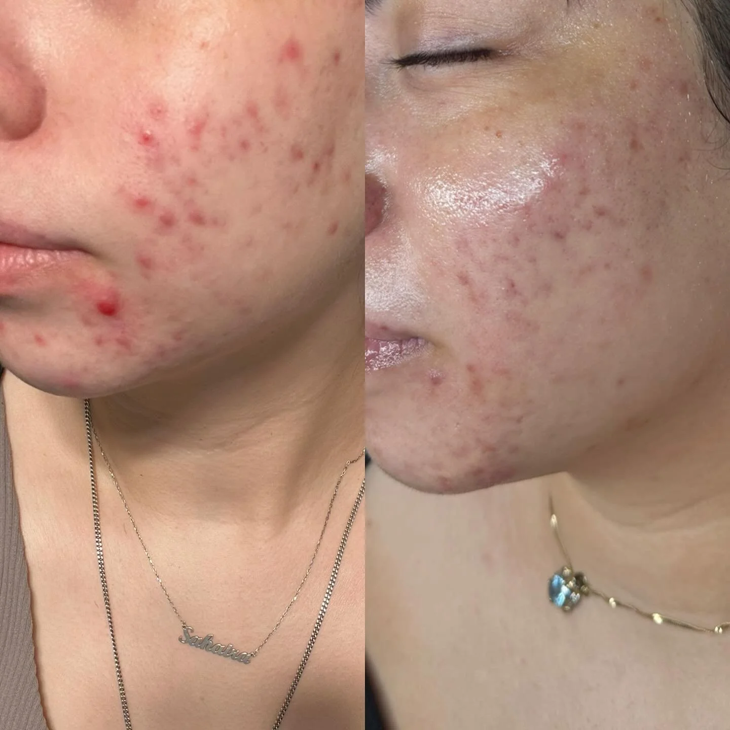 CONSISTENCY is key 

Not only with treatments but with facial products

A successful recovery consists of 20% treatments and 80% home care 🫶🏼

Click the link to book your first treatment 🔗
.
.
.
#acne #acnetreatment #skin #skinspecialist #beforean