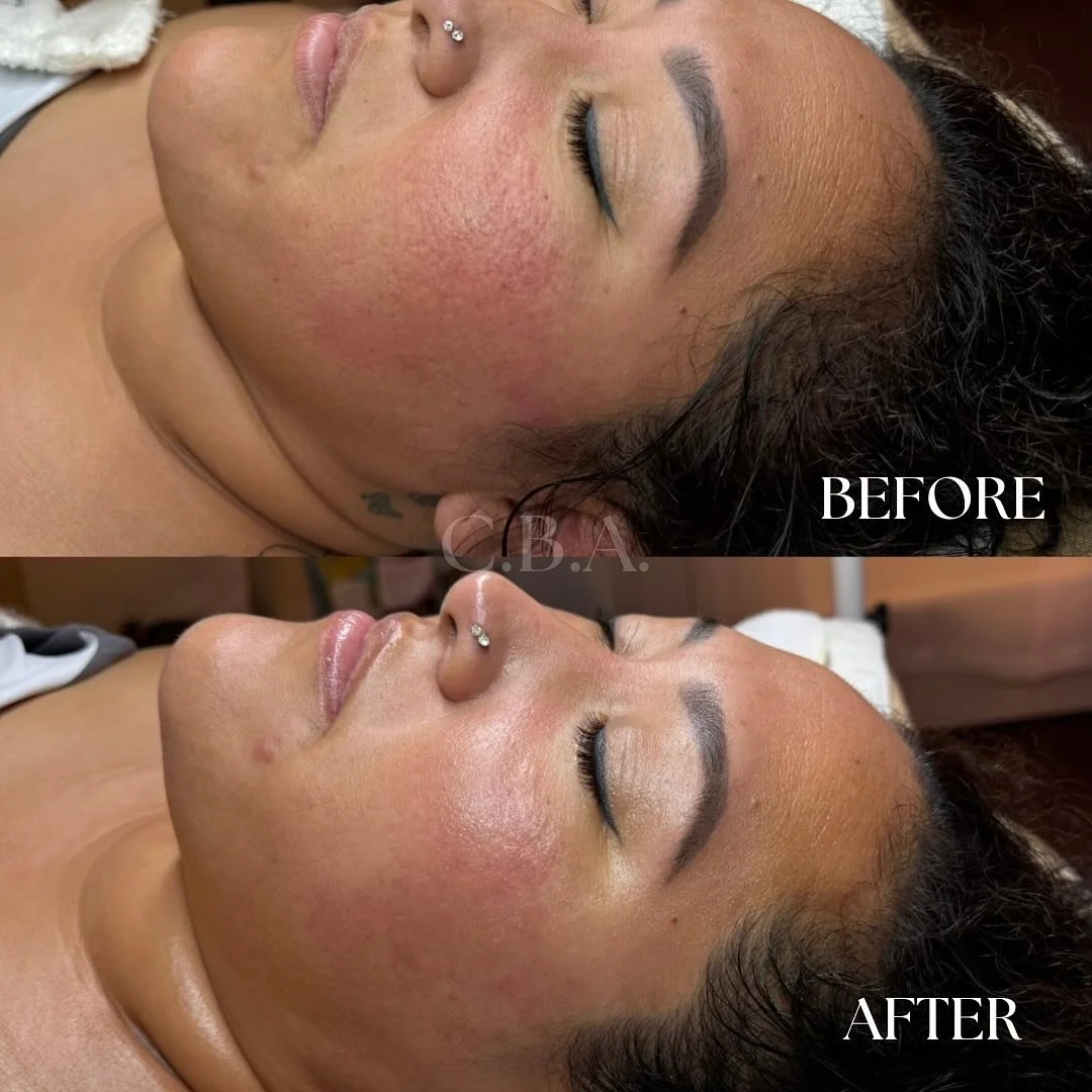 1 Plasma session immediately before and after ✨

-Her skin concerns: dehydrated/ dry / textured skin
-Treatment: Plasma Facial Treatment 
-Take home products: 
&bull;milk cleanser from DMK
&bull;herbal and mineral toner from DMK
&bull;Bio Hydra Infus