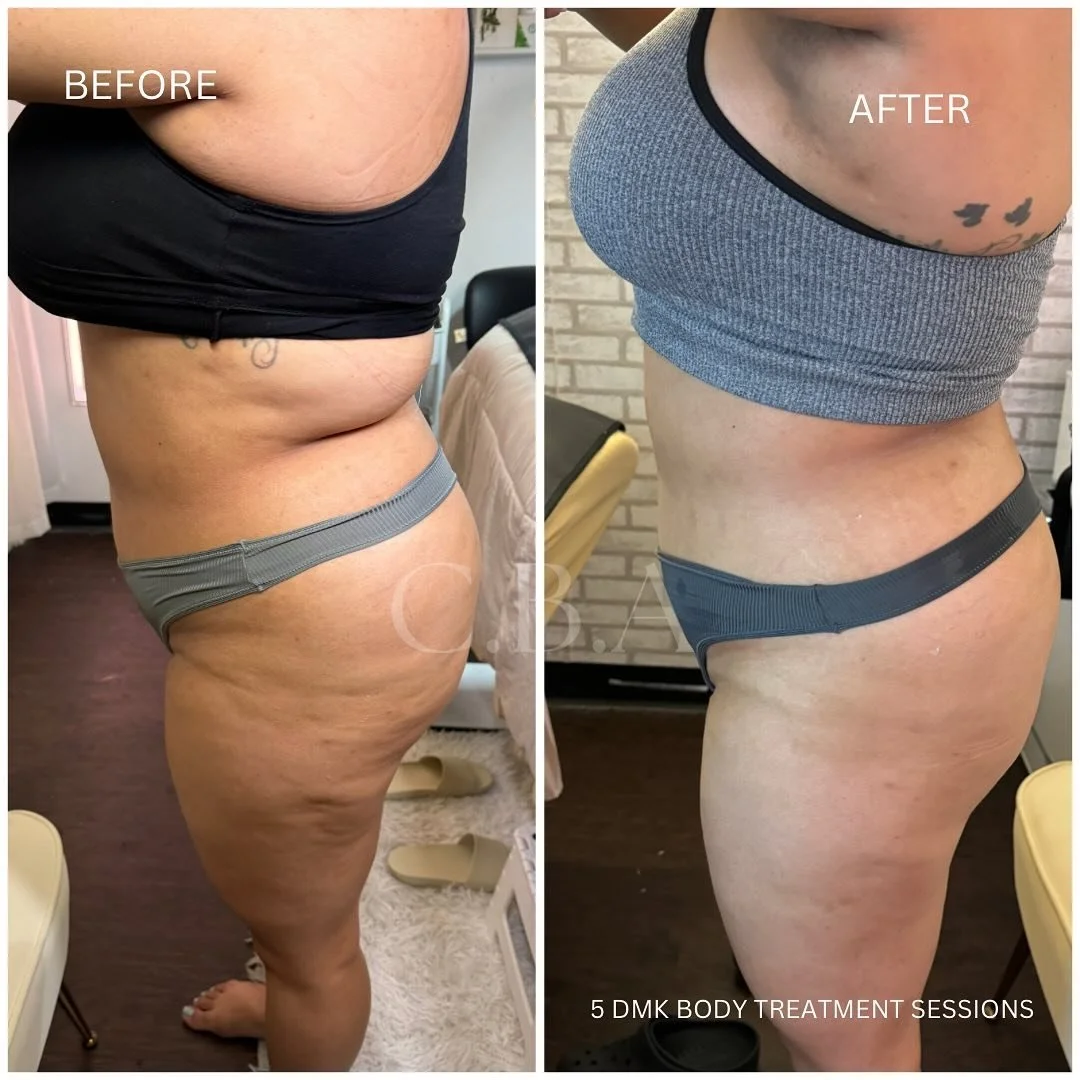 5 DMK BODY TREATMENTS LATER 🫶🏼

Her results consisted of:
- Consistency in treatments 
- Changes in daily habbits
- working out / keeping constant movement 

If you&rsquo;re serious about making a positive change in your body, feeling good not only