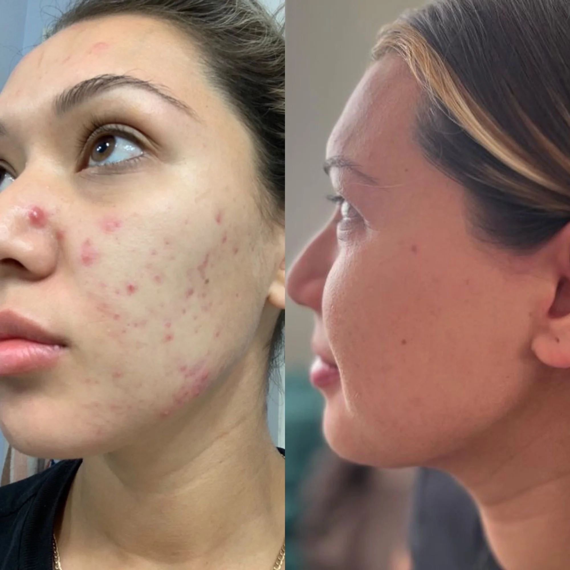 Before _ after dmk + biorepeel .jpg