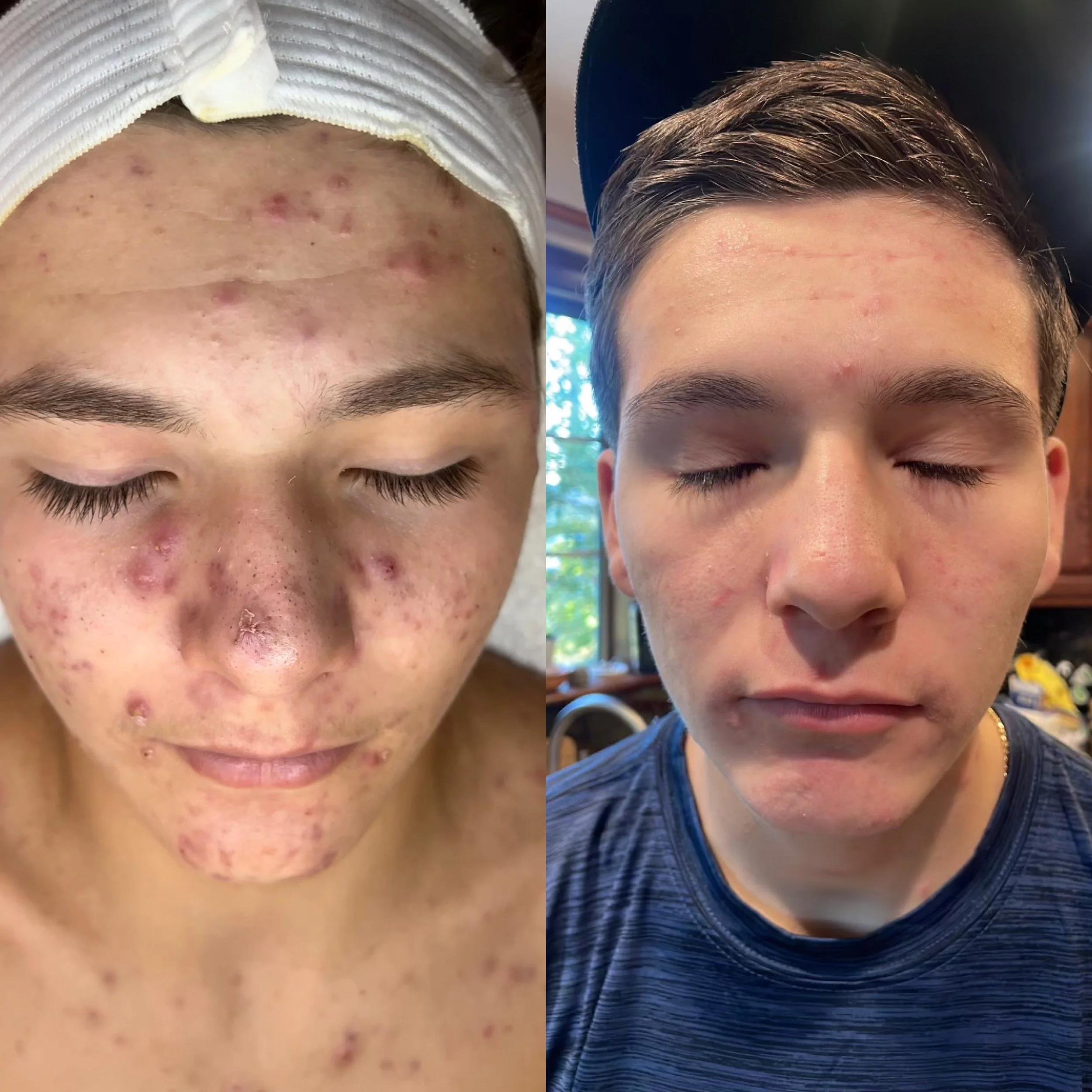 Before vs after DMK Treatment.JPG