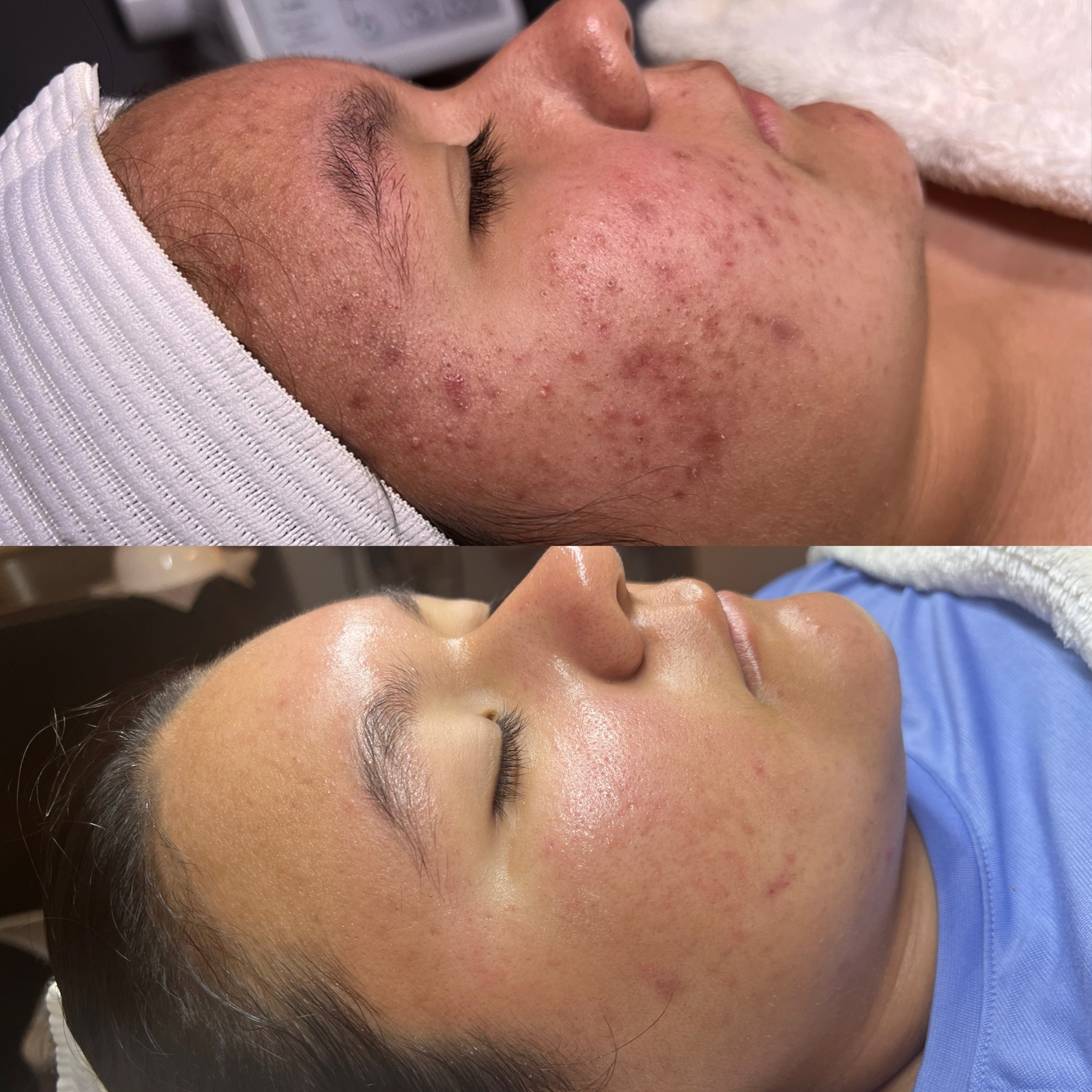 Before vs after custom facial (2).JPG