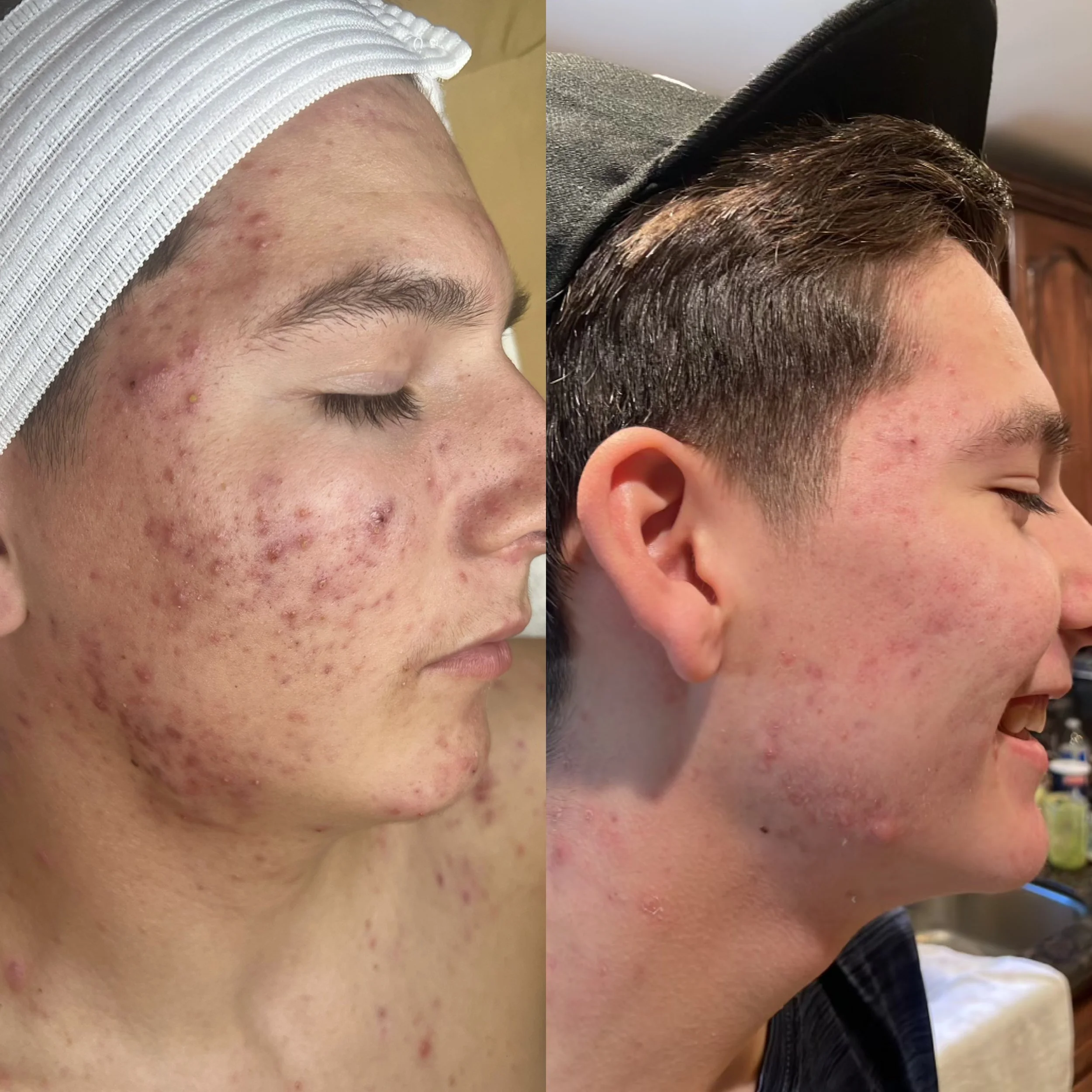 Before vs after DMK Treatment  (1).JPG
