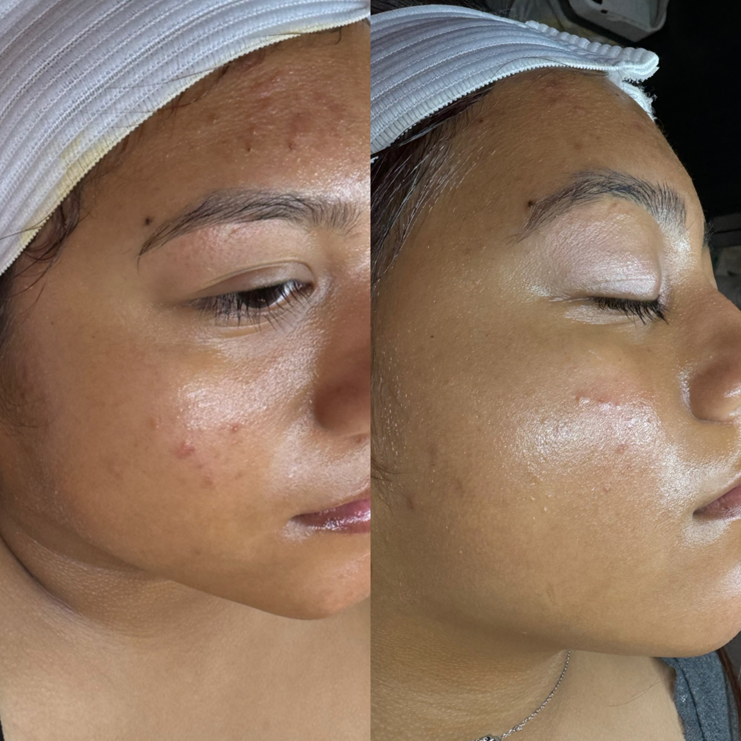 Before vs after custom facial.JPG