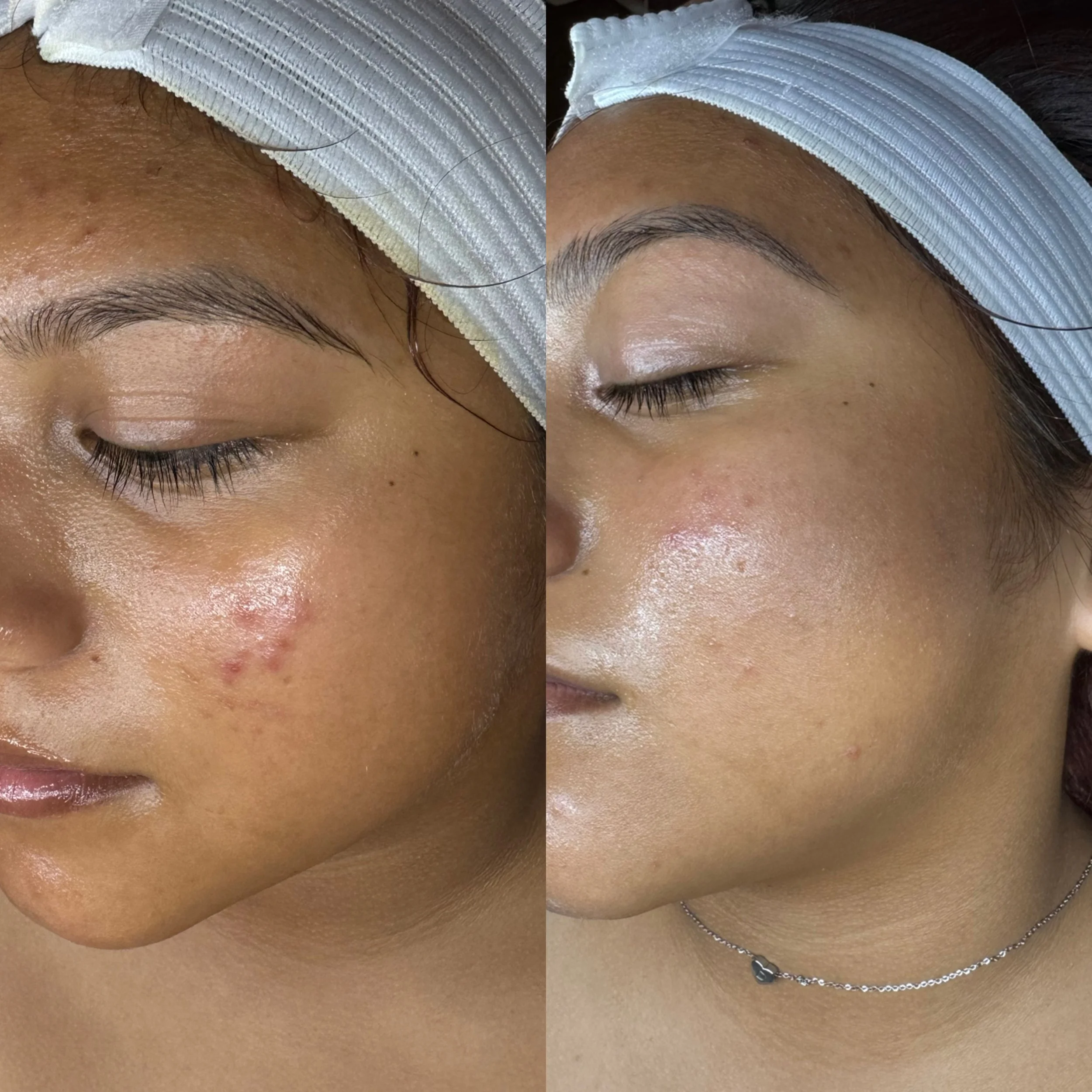 Before vs after custom facial (1).JPG