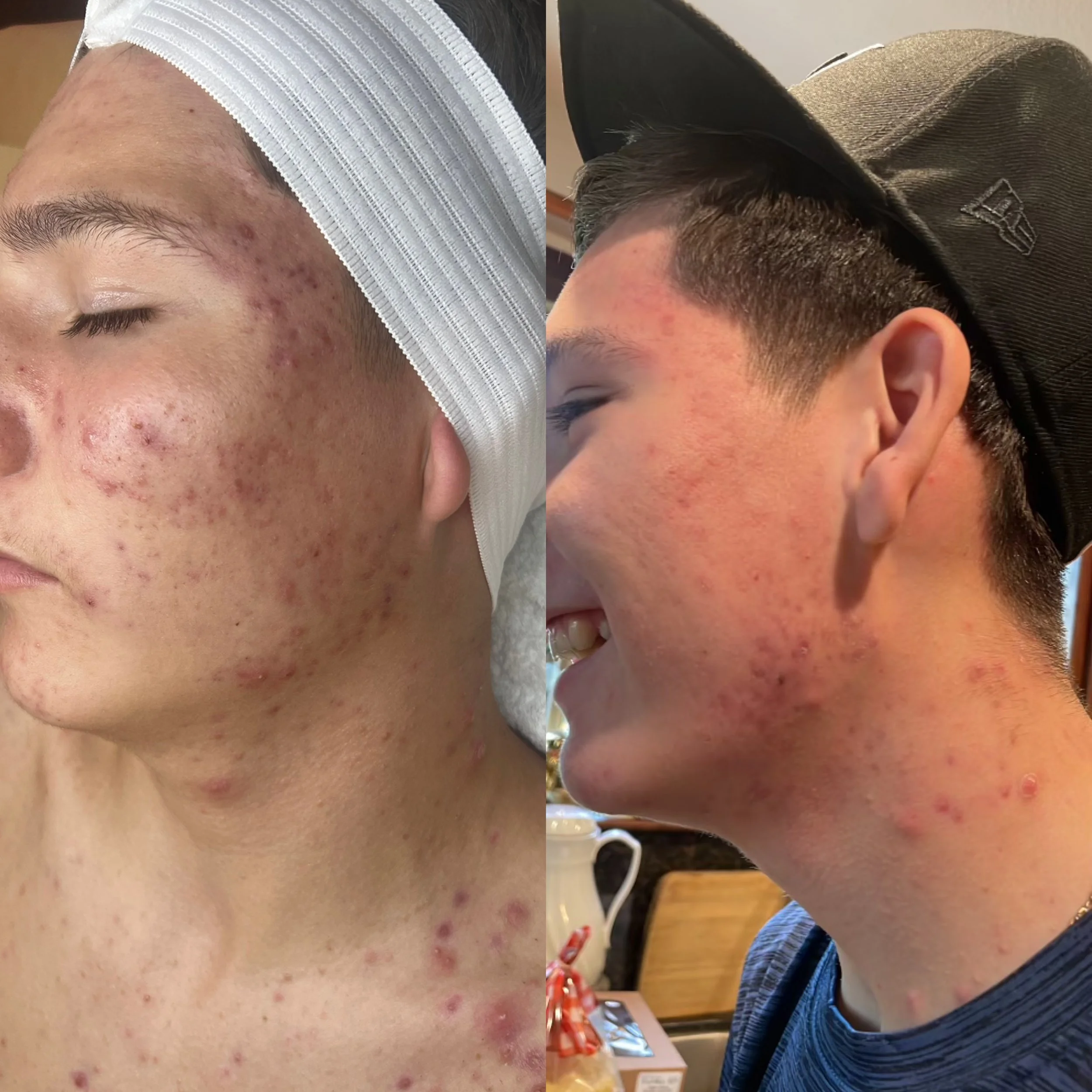 Before vs after DMK Treatment .JPG