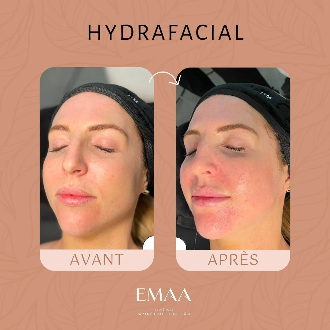 ✨ Avant / Apr&egrave;s

Regardez ce magnifique avant/apr&egrave;s d&rsquo;un soin Hydrafacial !

En une s&eacute;ance, la peau est visiblement transform&eacute;e : plus lisse, &eacute;clatante et hydrat&eacute;e en profondeur. L&rsquo;Hydrafacial net