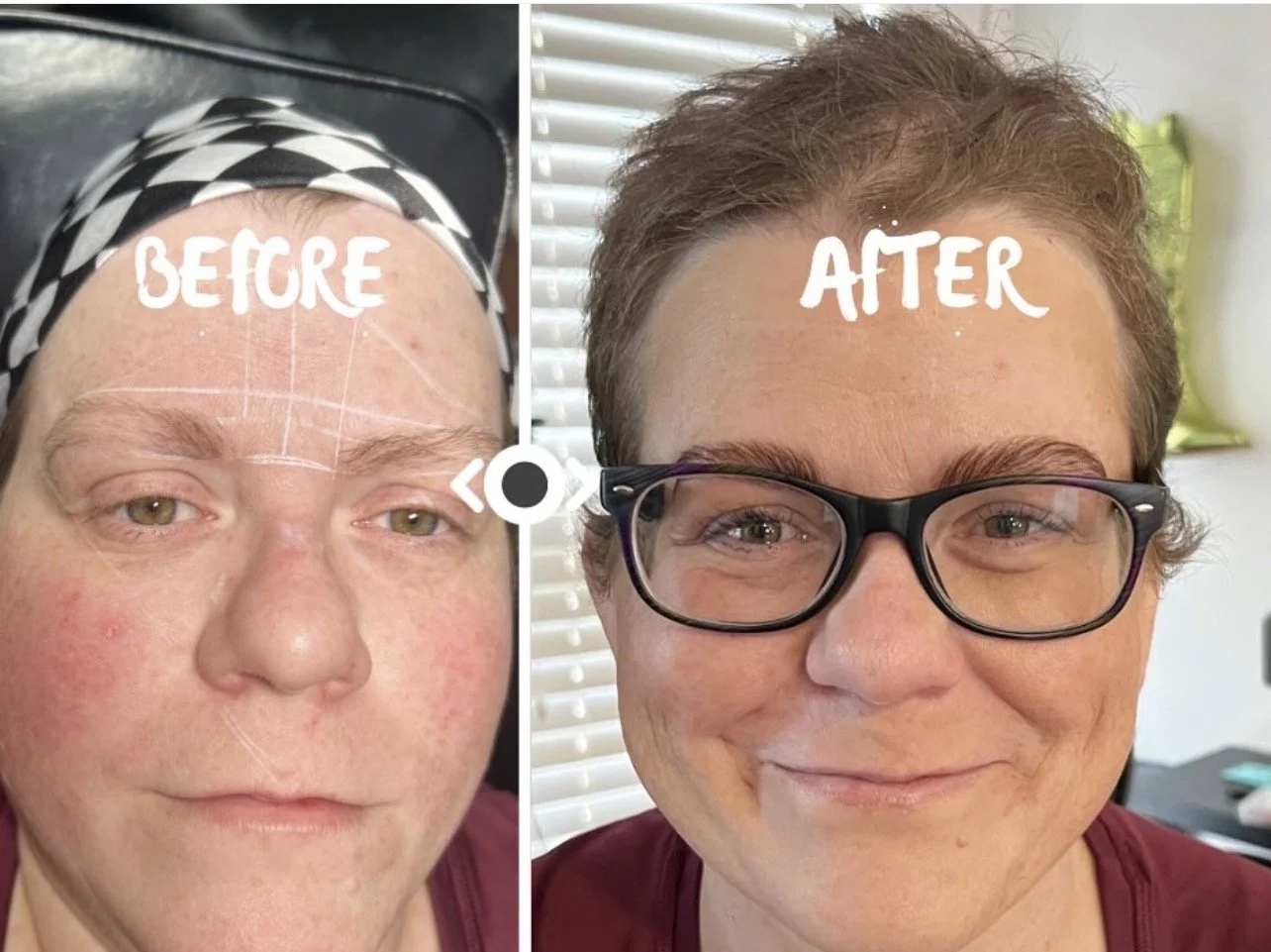 Side-by-side comparison of a woman's face before and after cosmetic treatment. The 'before' shows red, uneven skin and signs of aging, while the 'after' depicts smoother skin and a brightened appearance with glasses. The words 'BEFORE' and 'AFTER' ar