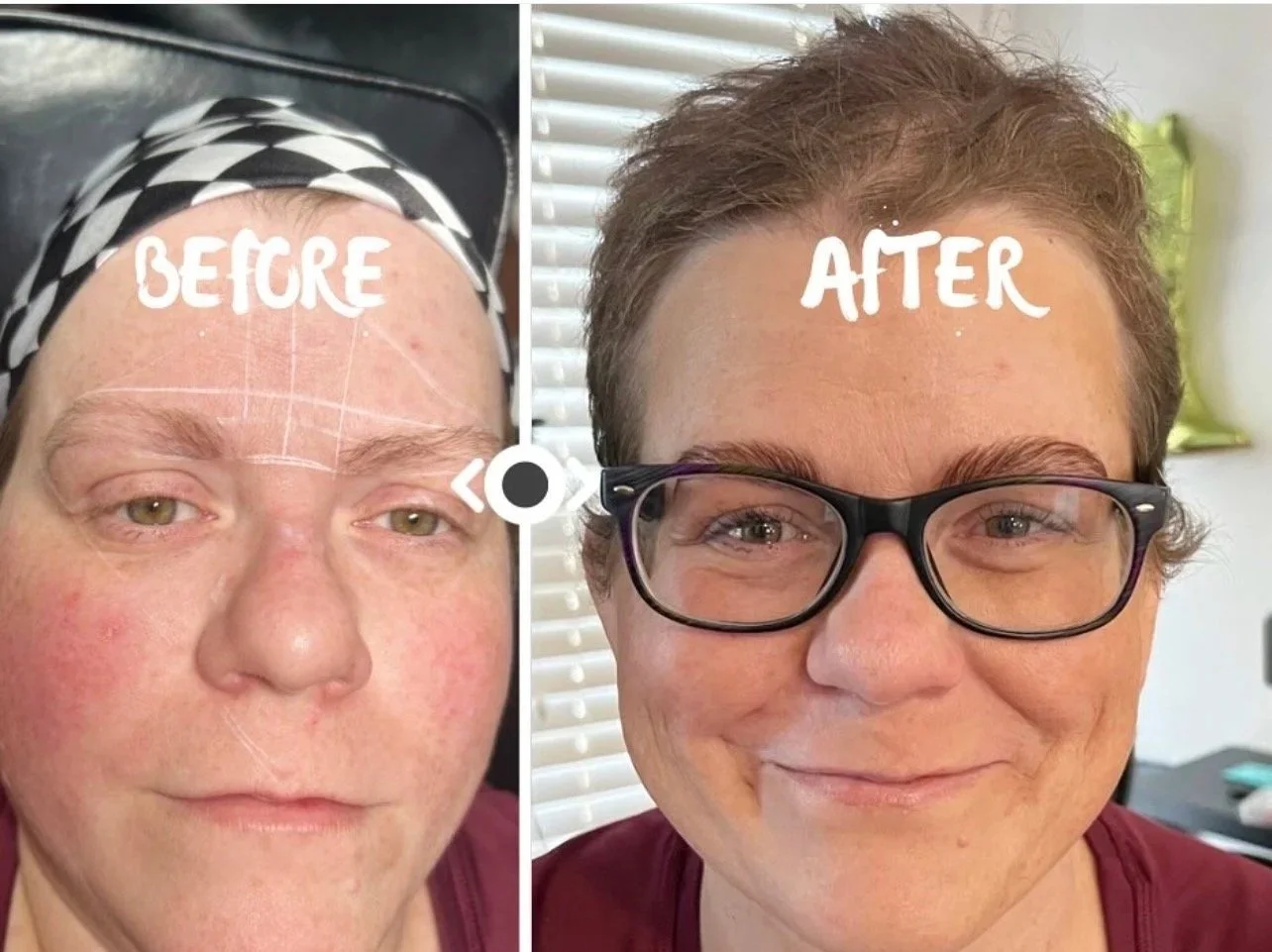Side-by-side comparison of a woman before and after cosmetic procedure. The left image labeled 'BEFORE' shows her with redness and uneven skin tone, while the right image labeled 'AFTER' shows her with clearer skin and glasses, smiling at the camera.