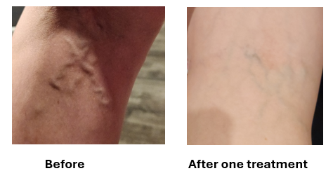 Acupuncture for Varicose Veins: A Clinical Case of Reduced Pain, Puffiness and Vein Prominence