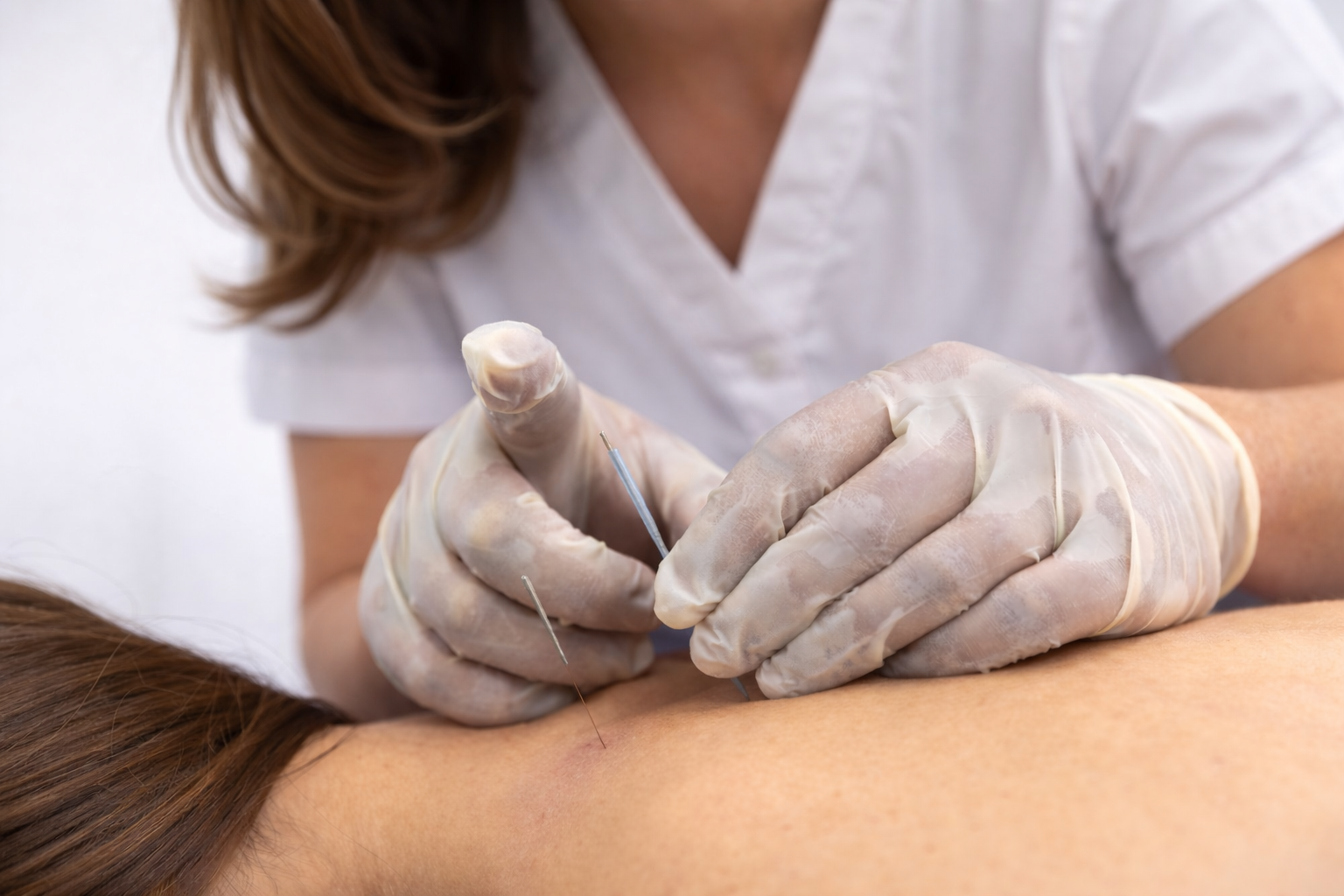 Close-up of a female healthcare practitioner performing dry needling on a patient’s shoulder, focusing on the needle insertion technique