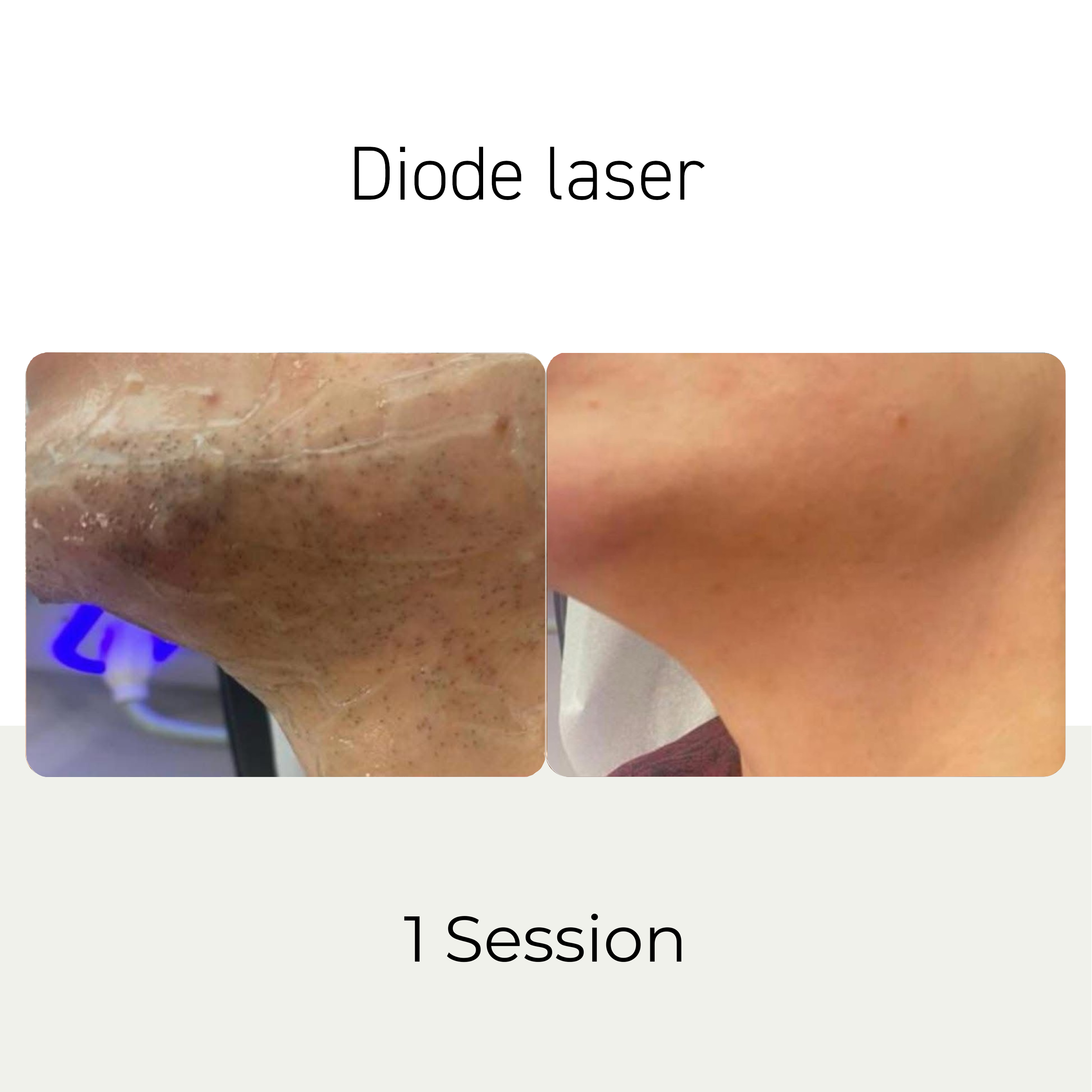 diode laser b&e1.png