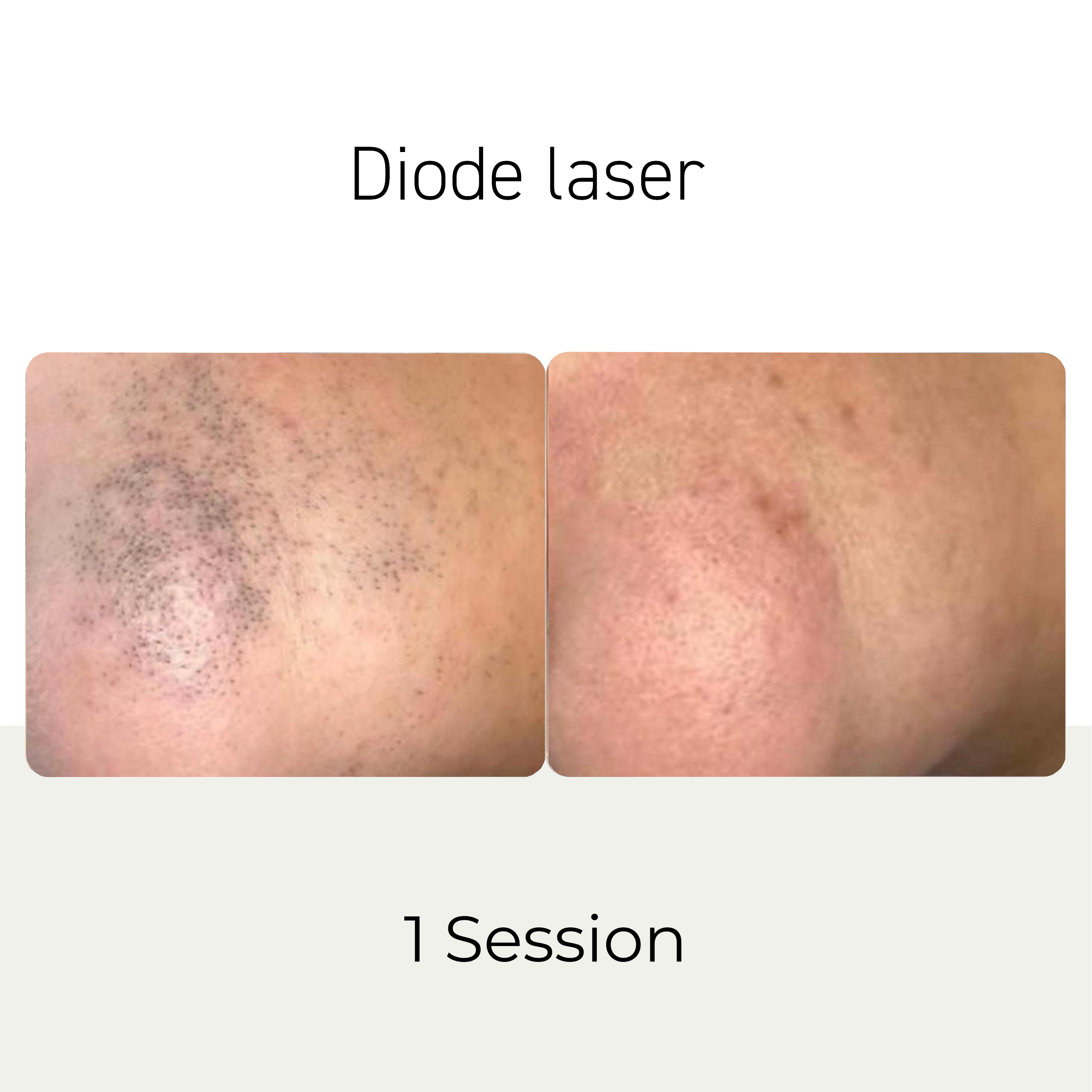 diode laser b&e2.png