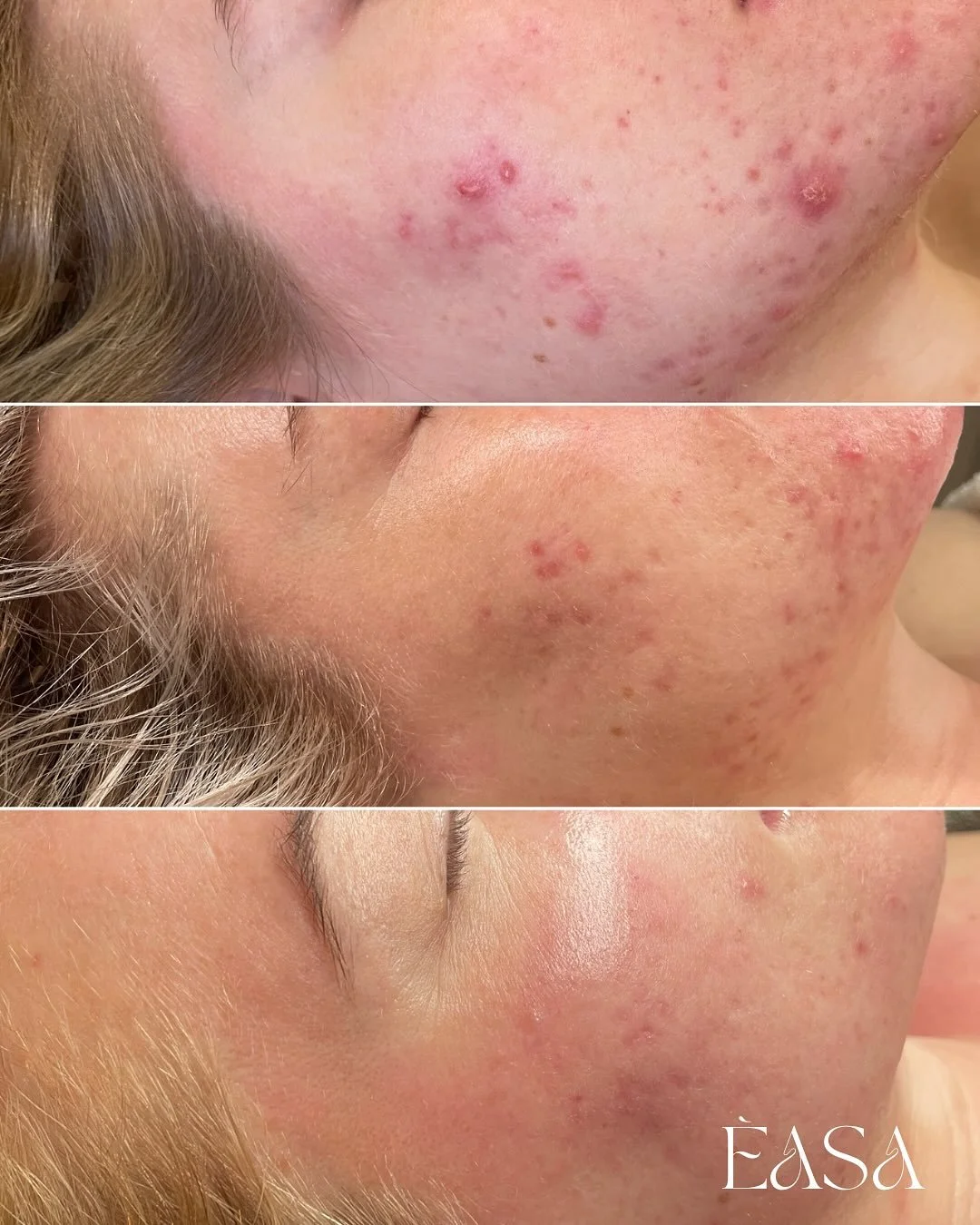 Time - Consistency - Trust 🤍

This is the result when you mix a trusting client and a passionate skin therapist together. 

It&rsquo;s the magic of advanced formulations &mdash; I work exclusively with skincare lines that focus on helping the skin f