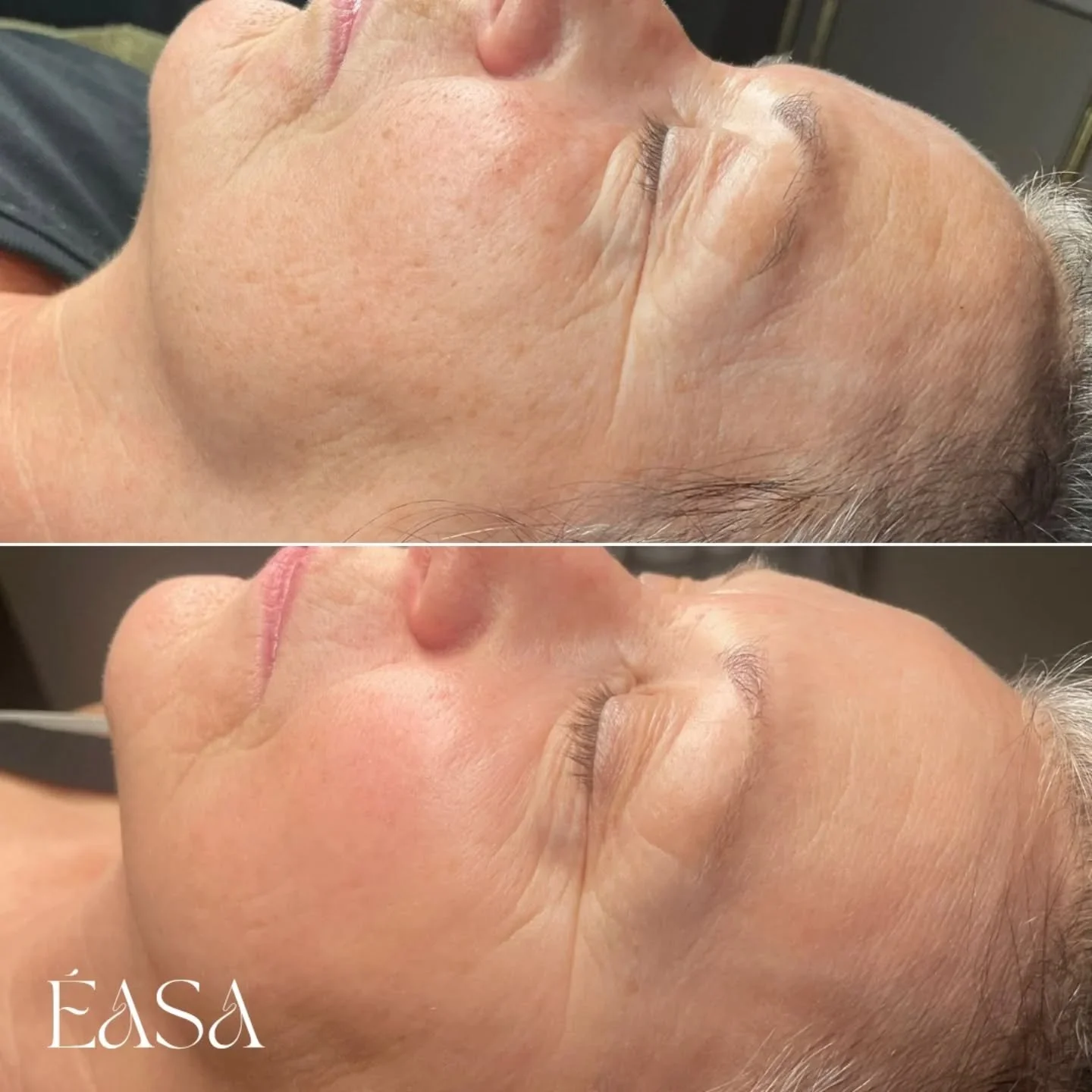 Incredible results from @sqt_uk ✨

Are you ready to transform your skin confidence ? 

Link in bio to book 🤍

&Eacute;asa x 

#sqtliquidneedling 
#advancedfacialsedinburgh 
#matureskinrevival 
#edinburghfacials 
#holisticfacialist