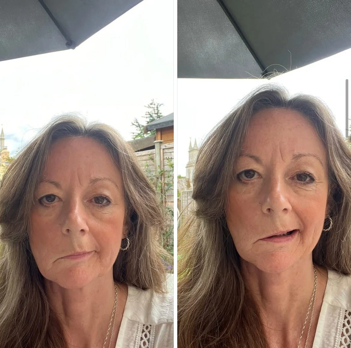 When a Face Changes:  Living with Permanent Facial Paralysis