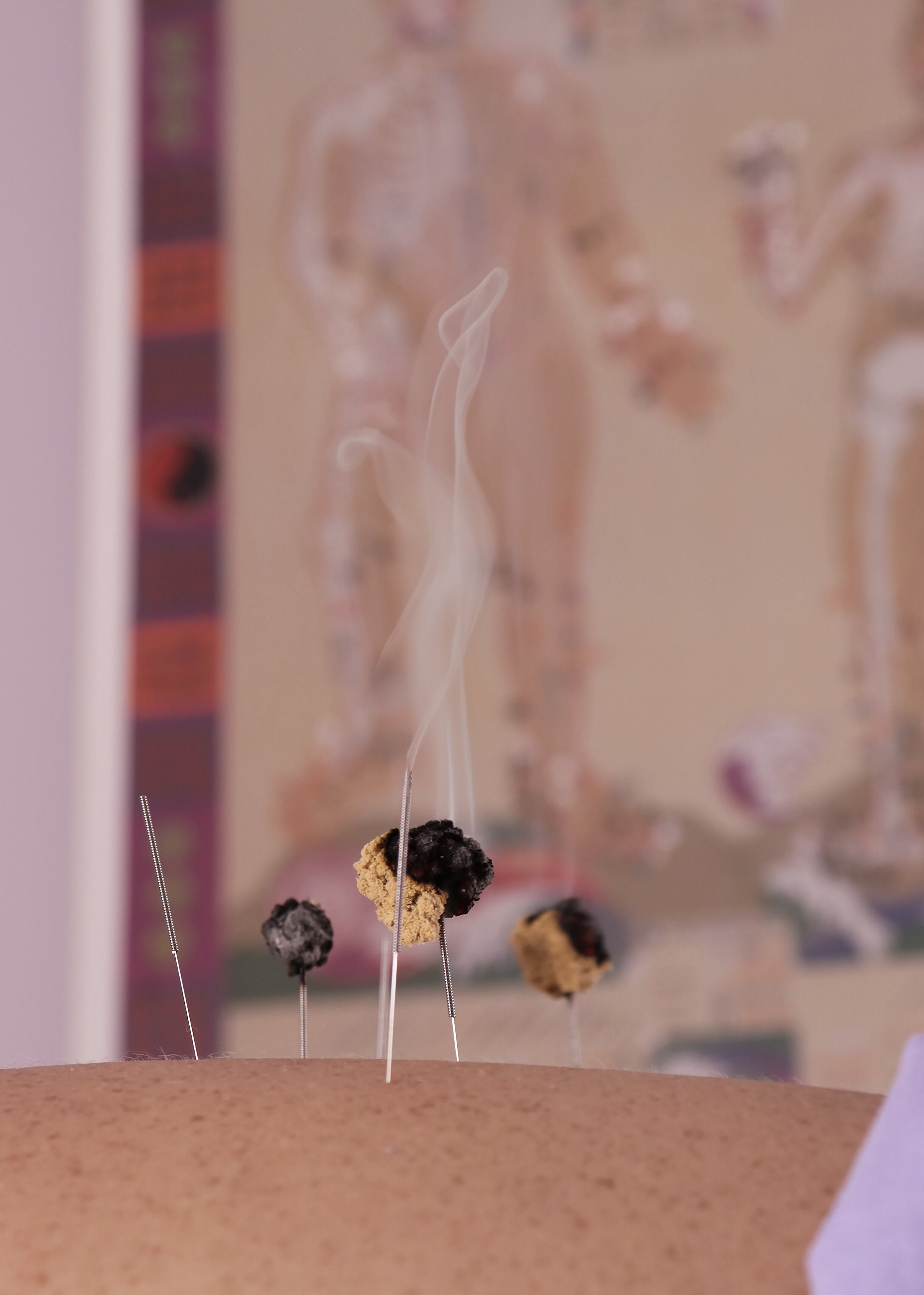 A person's back with several acupuncture needles with moxa moxibustion sticks attached, producing smoke and heat on the skin.