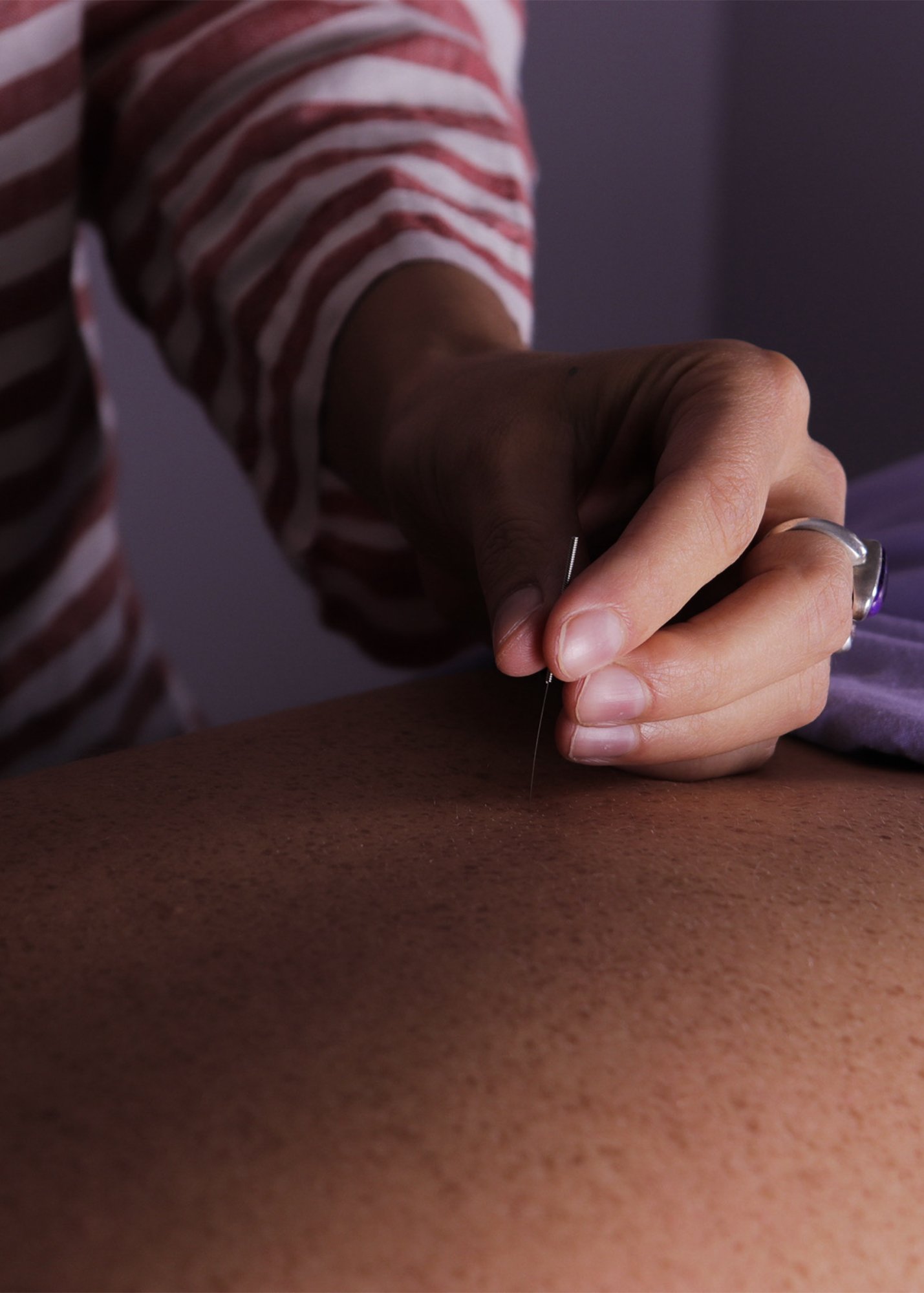 A person using an acupuncture needle on a patient's back.