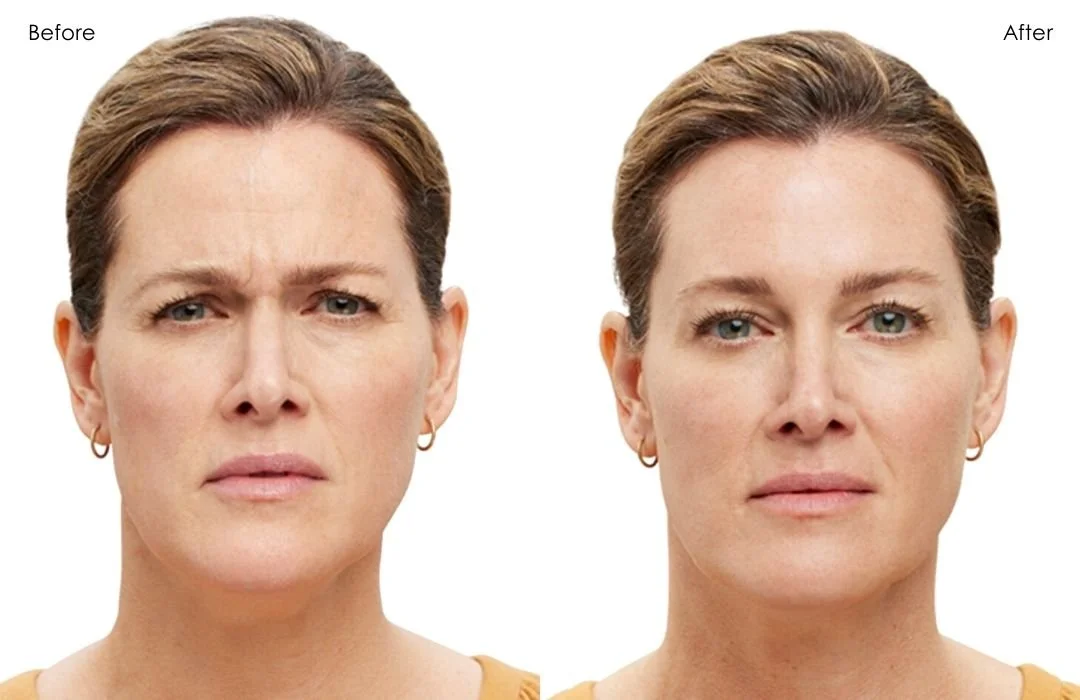 BOTOX® Cosmetic: Frown Lines Before & After