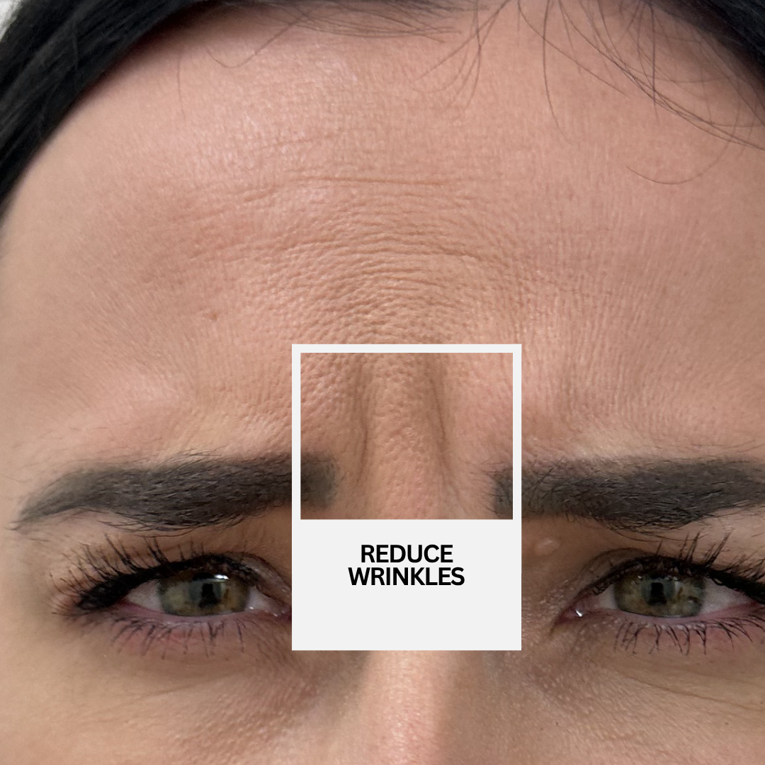 Redurce wrinkles