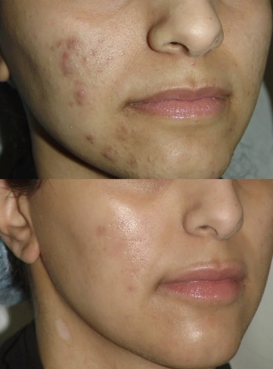 Close-up of a person's face before and after acne treatment, showing clear skin in the after image.