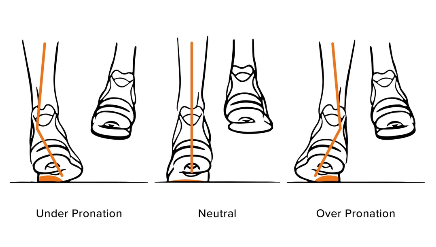 drawings 3 pairs of ankles; one in under pronation, one in neutral position, and the final one demonstrating over pronation