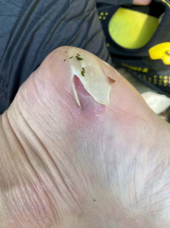 busted open blister across the entire bottom of the heel