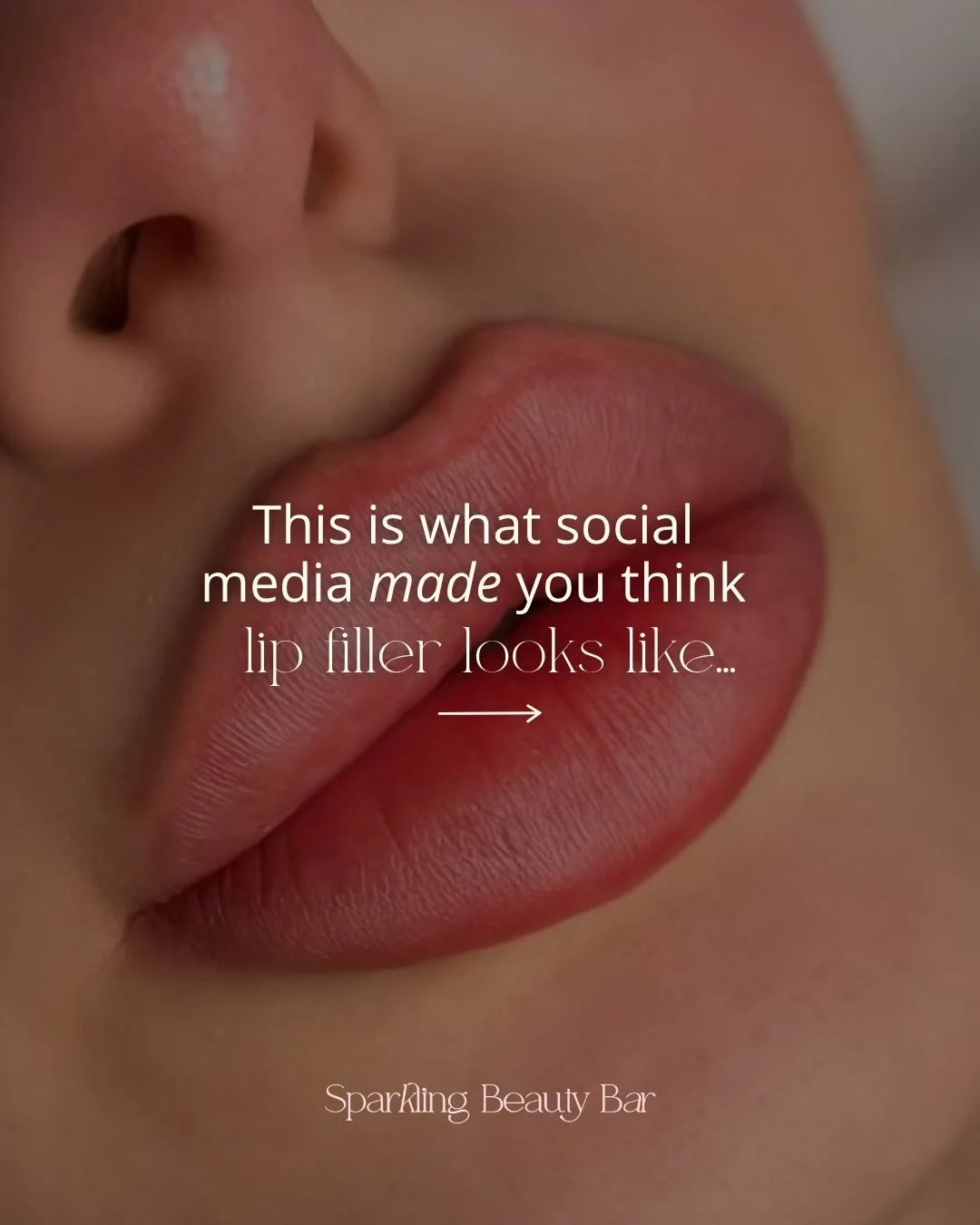 Chances are, the best lip filler you&rsquo;ve seen&hellip; you didn&rsquo;t even notice. 👄💉That&rsquo;s because good filler isn&rsquo;t meant to stand out. It&rsquo;s meant to blend seamlessly into your natural features.⁠
⁠
When done correctly, lip