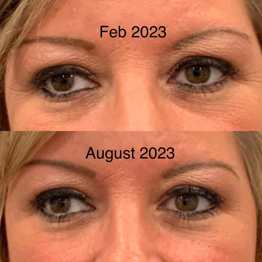 Dysport and SkinBetter Interfuse Eyes.jpeg