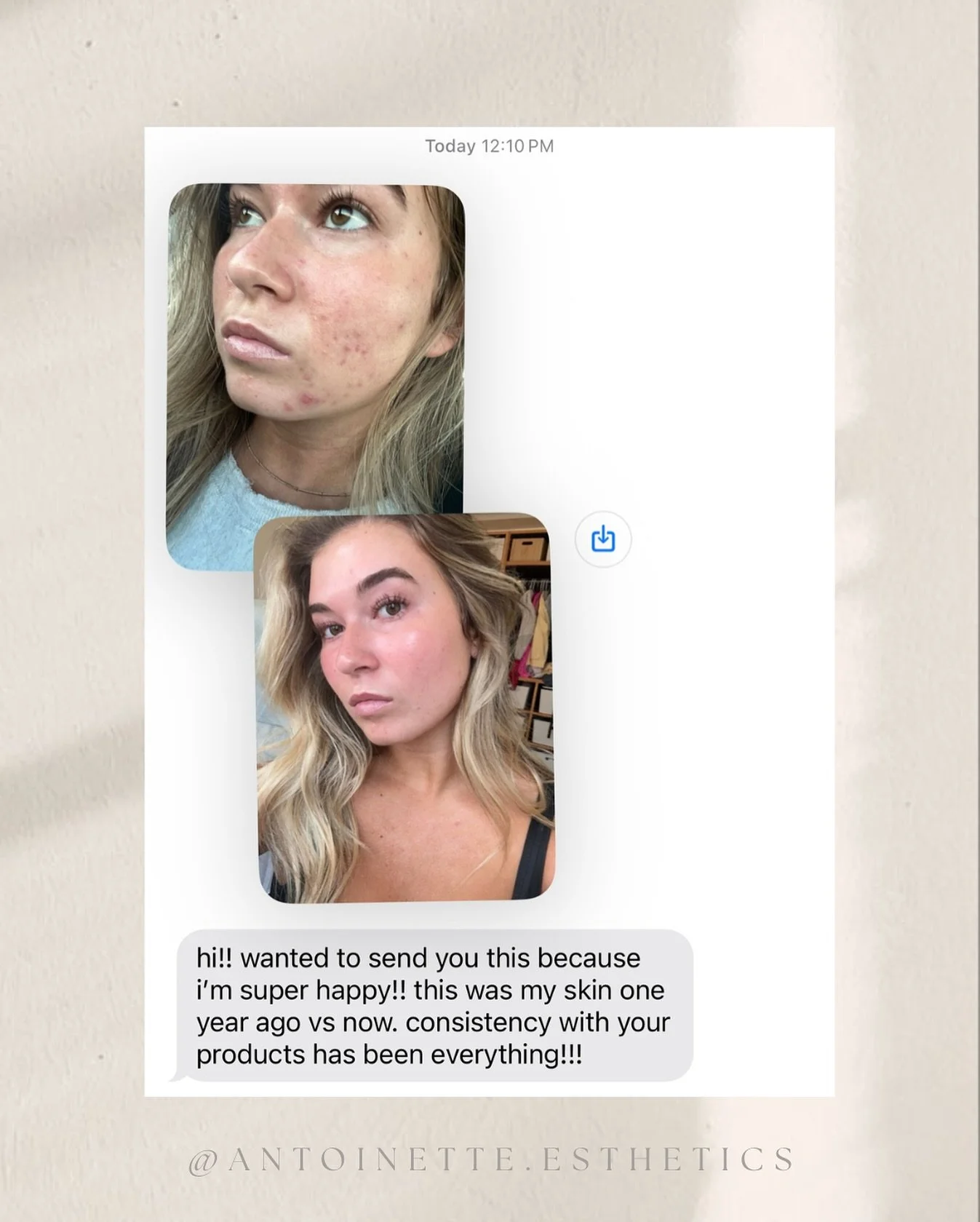 Consistency is truly the key 🗝️ 

Clear skin doesn&rsquo;t happen overnight&mdash;it takes the right products, professional guidance, and staying consistent with your routine!👏🏼