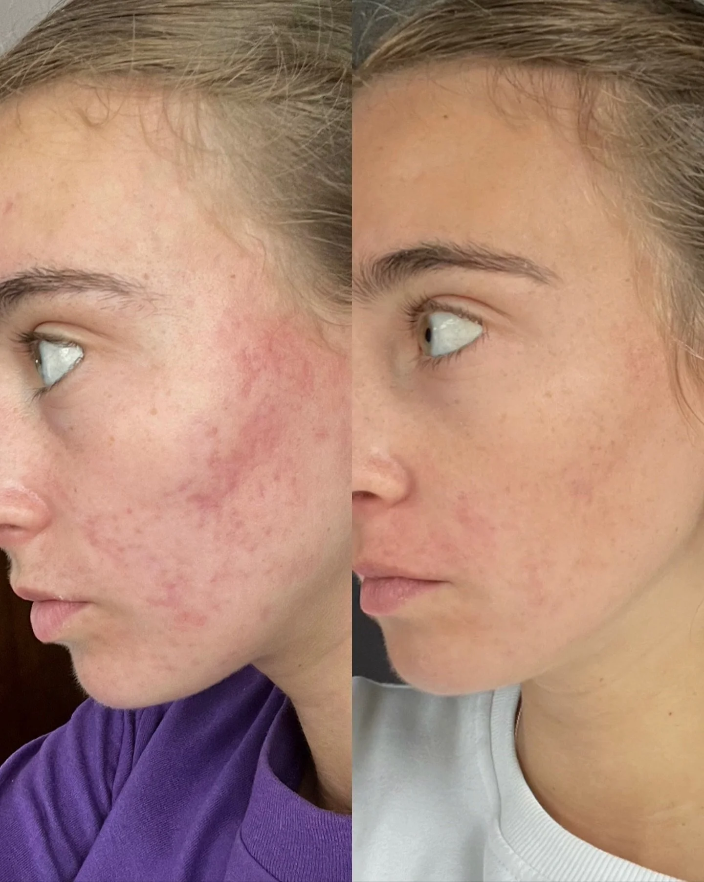 After the skin is cleared I hear a lot of clients say &ldquo;what about my scarring?&rdquo; 

Well the skin takes time to heal! Just like a cut takes time to heal and completely go away. If you were to use nothing on a wound or cut the chances of it 