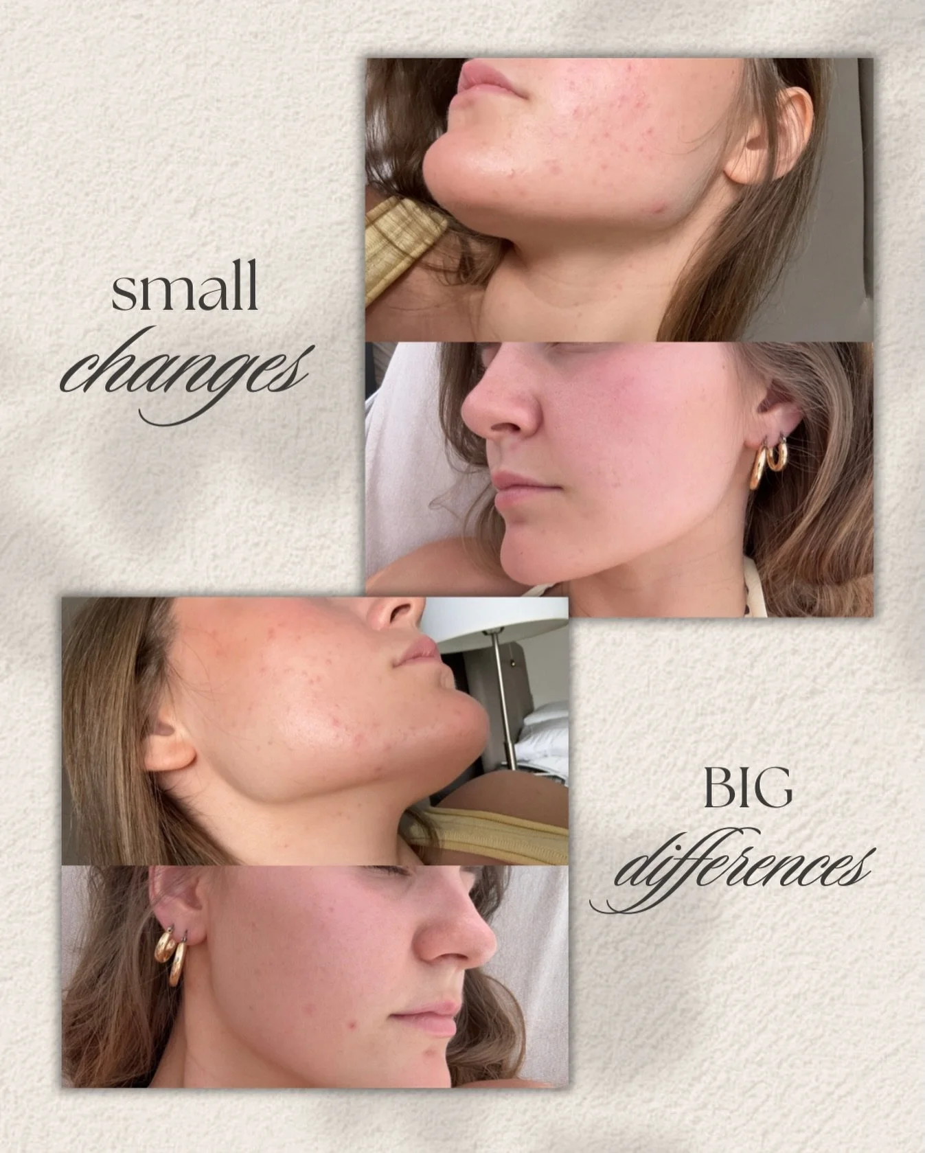 all she needed was @lumielleskin glass skin liquid exfoliant &amp; @glymedplus comfort cream to save the day!!!👏🏼🤍 

&amp; this is why you shouldn&rsquo;t use rhode glazing milk pls &amp; thanks!!!😅