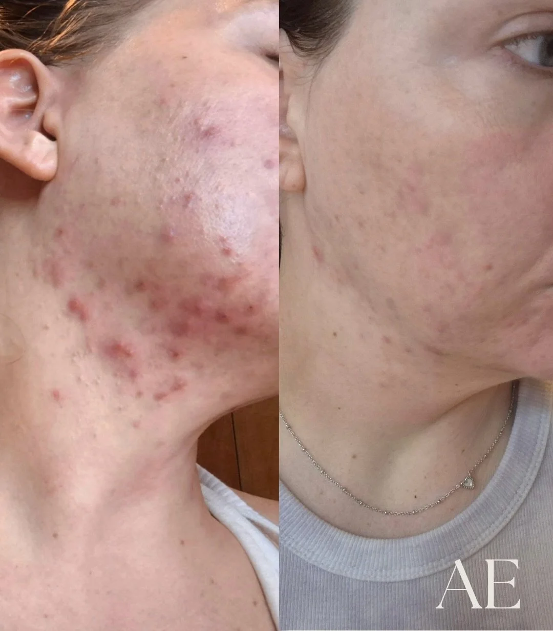 when we first met she told me how bad she wanted to just wear a tinted spf and not a foundation.. 

challenge accepted!!👏🏼🩵 

5 months into her new regime &amp; a few custom acne treatments and she is on her way to clear and healthy skin!!🥺