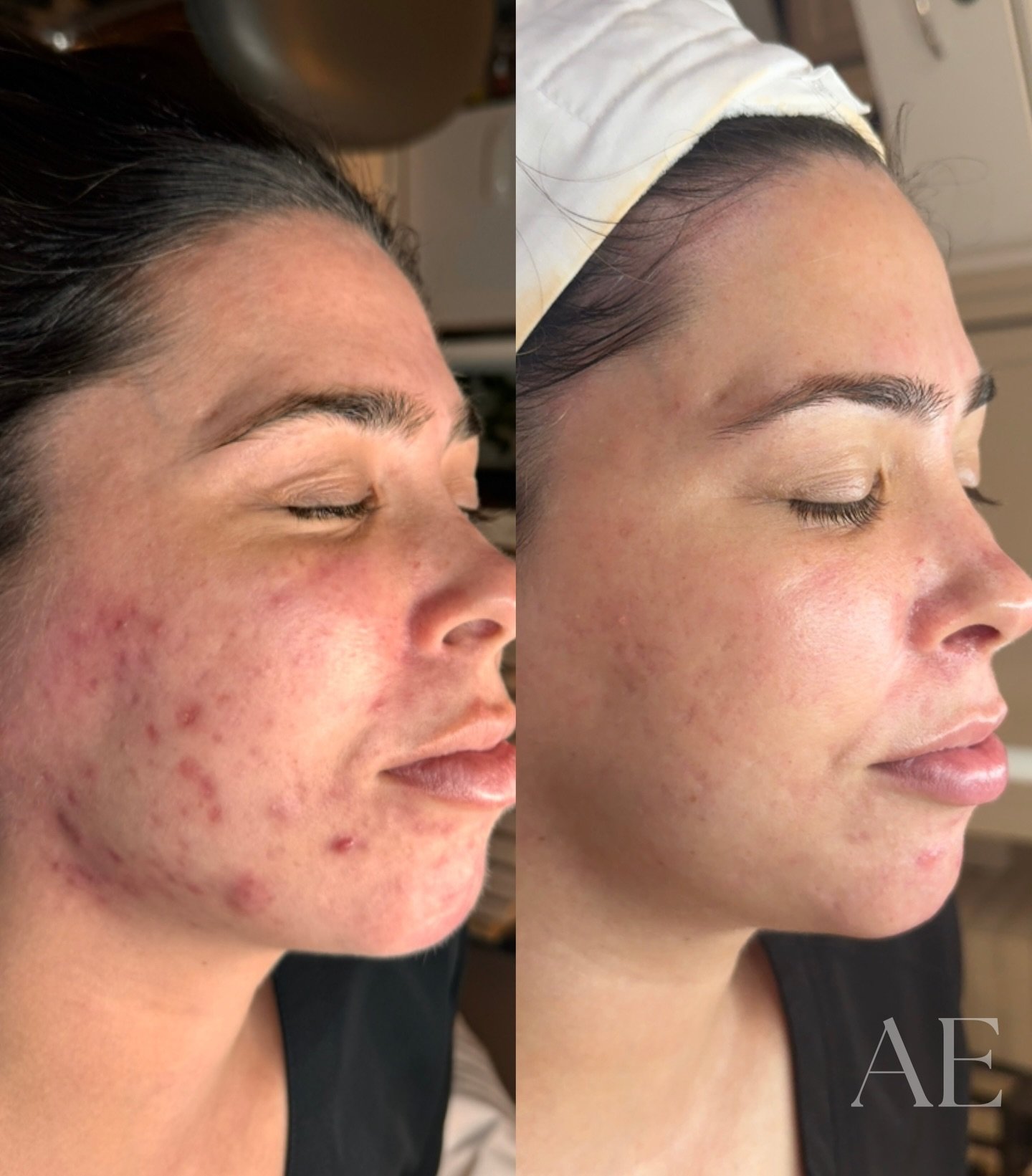this girl &amp; transformation has a super special place in my heart 🫶🏼 

(scroll to see her testimonial) 🥺

when she first saw me she had been struggling with acne for over 10 years&mdash; had tried everything the derms has to over (multiple time